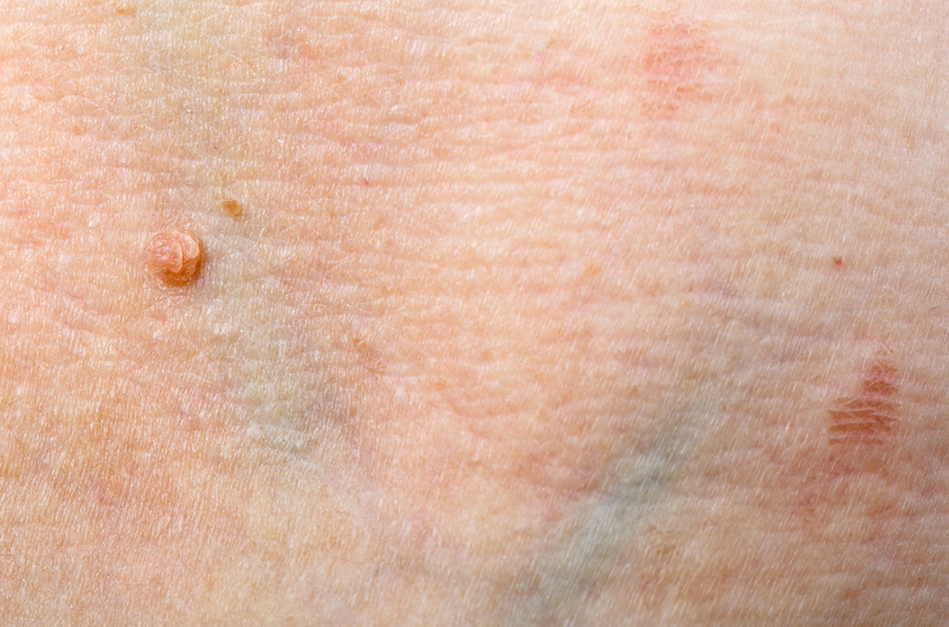 尖锐湿疣的症状其实比较明显,就是在皮肤表面出现颗粒状或菜花状的