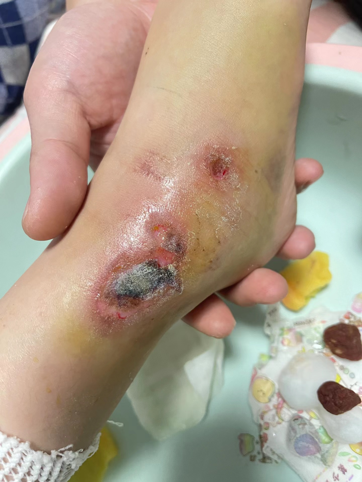现在伤口慢慢结痂好了,已经医院小女孩脚烂到骨头图片真实