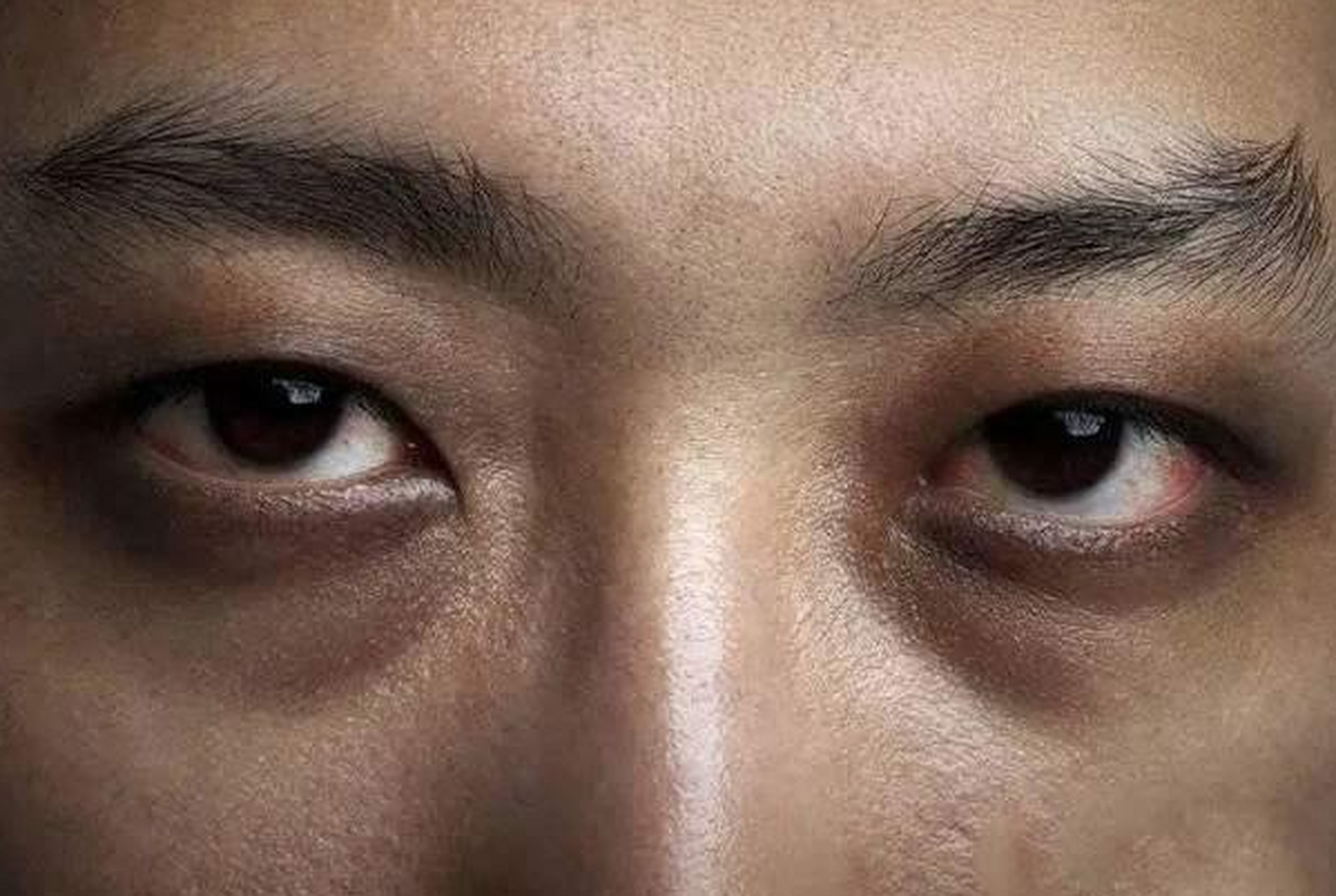 肝硬化面部发黑一般是失代偿期表现.