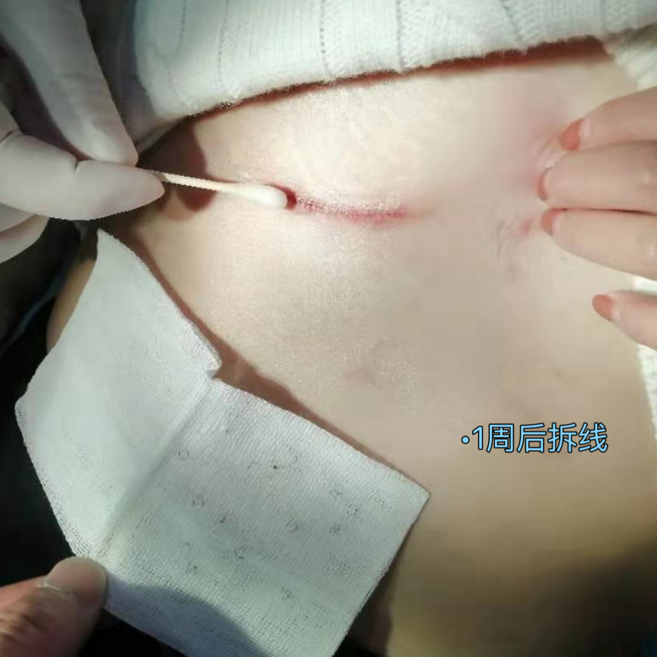 上周安排的手术,「胸部增生性疤痕」重新切缝修复,这周过来拆线.