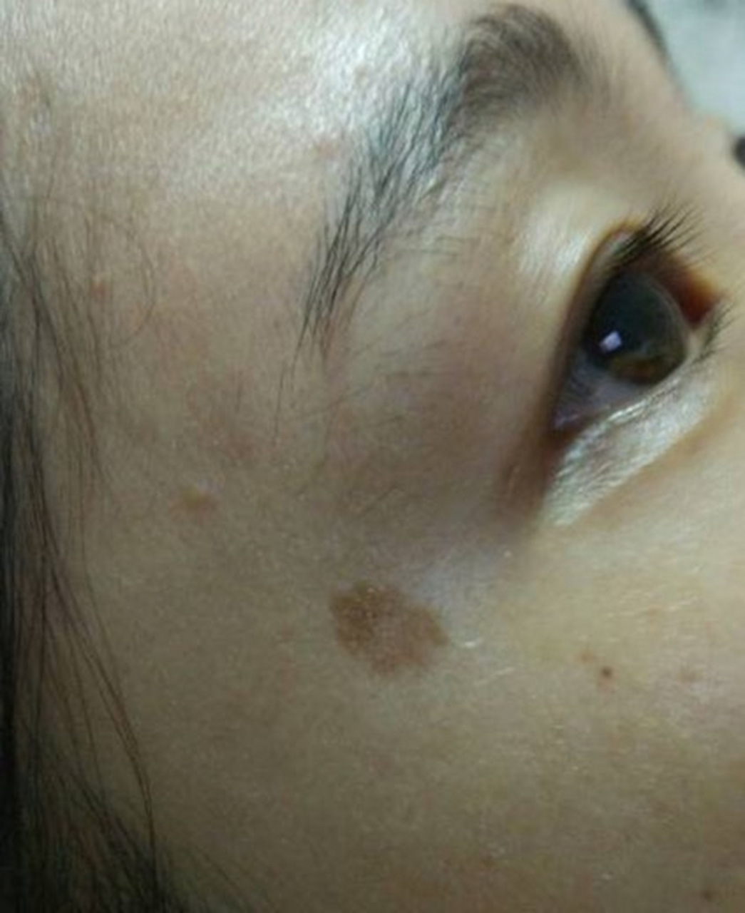 眼角长斑是指在眼睑或眼角周围出现的色素沉着或色素斑点.