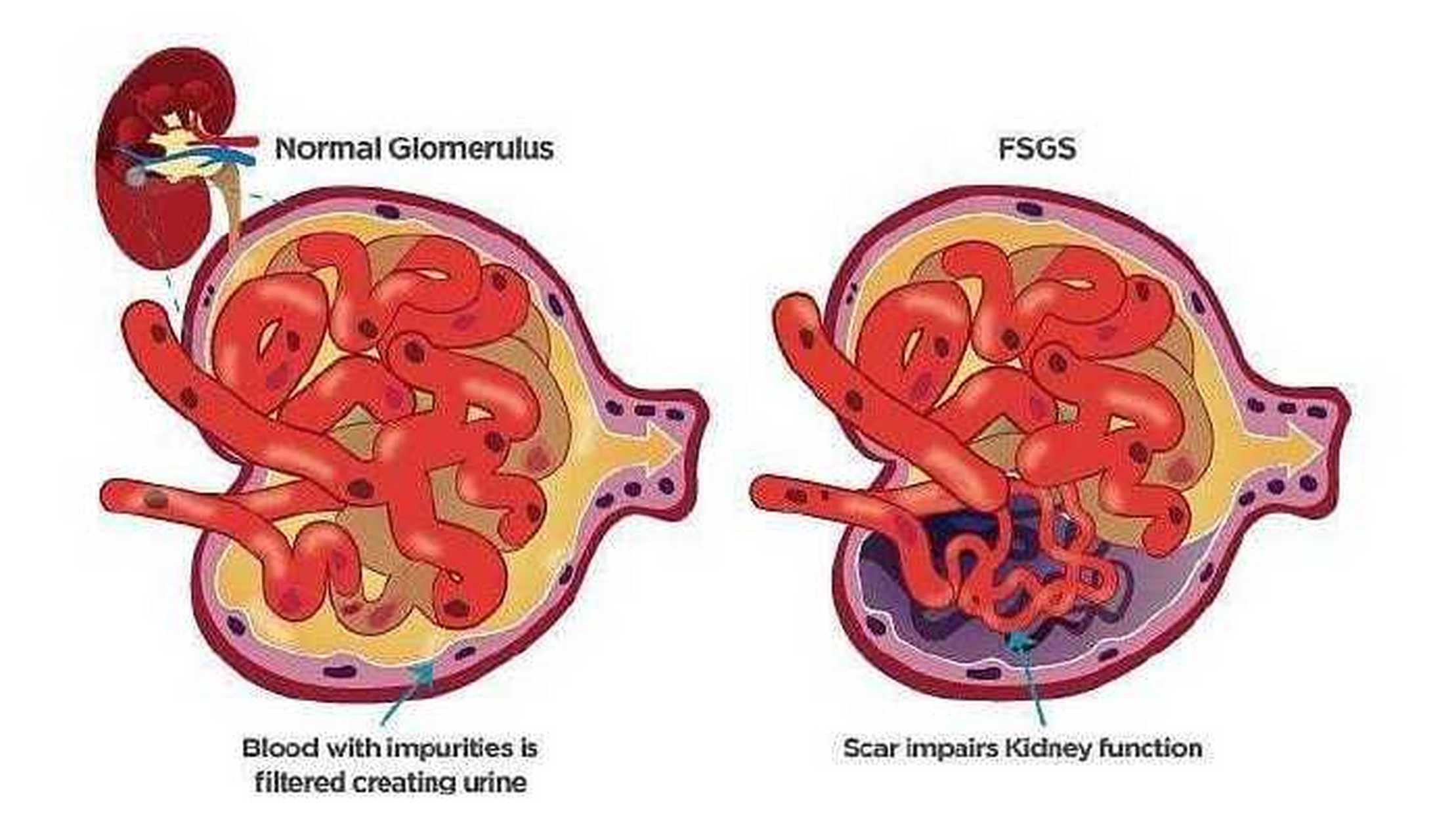 局灶节段性肾小球硬化(fsgs)的病理