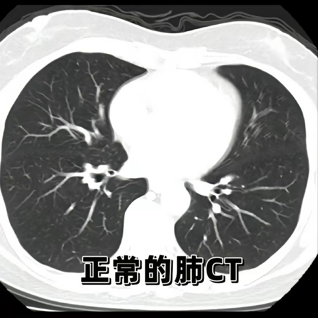 肺结节ct图片螺旋图片