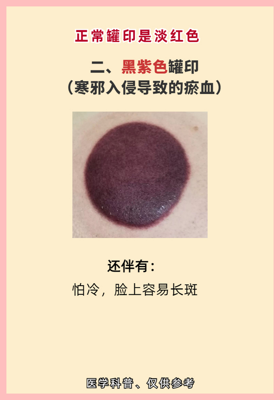 拔罐真的能治病?拔出来黑,紫,青,红各色的罐印都说明什么?