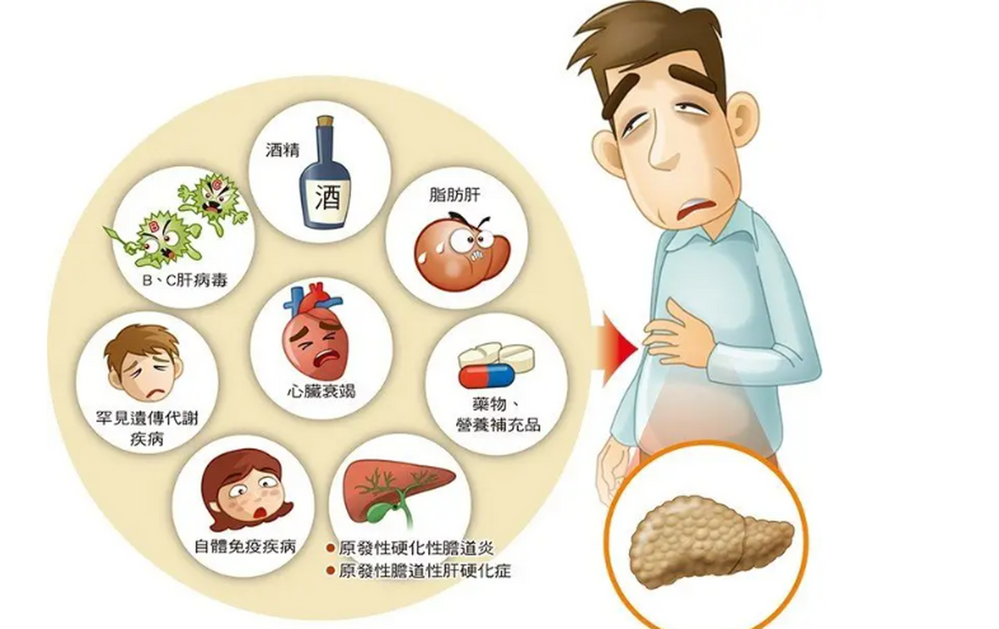 千万别肝病当成胃病,这是肝硬化的早期症状啊!