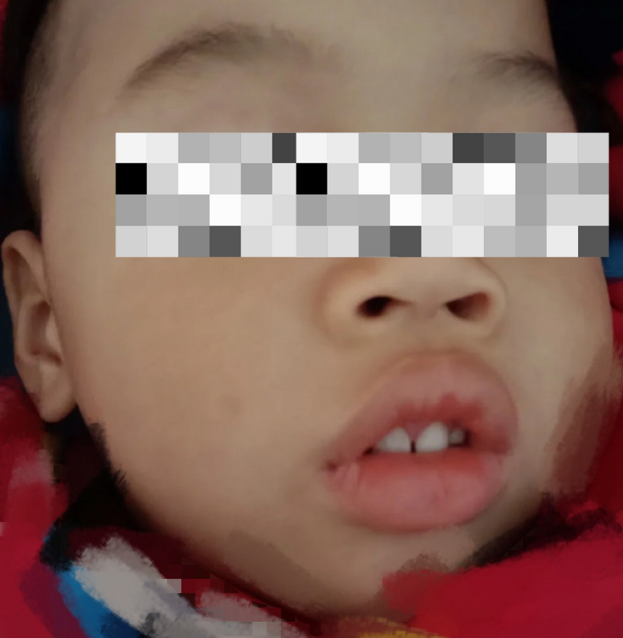 儿童鼻咽部腺样体增生图片