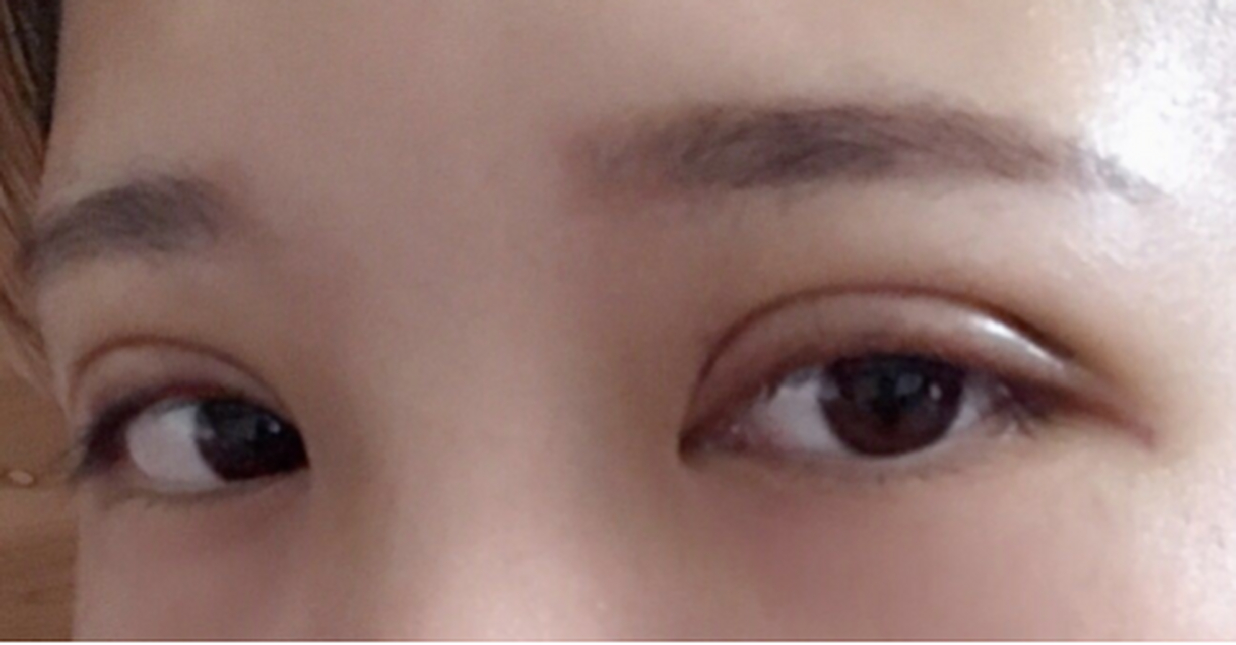 双眼皮术后出现"肉条感",一般是因为眼部脂肪比较多或者睑板前组织