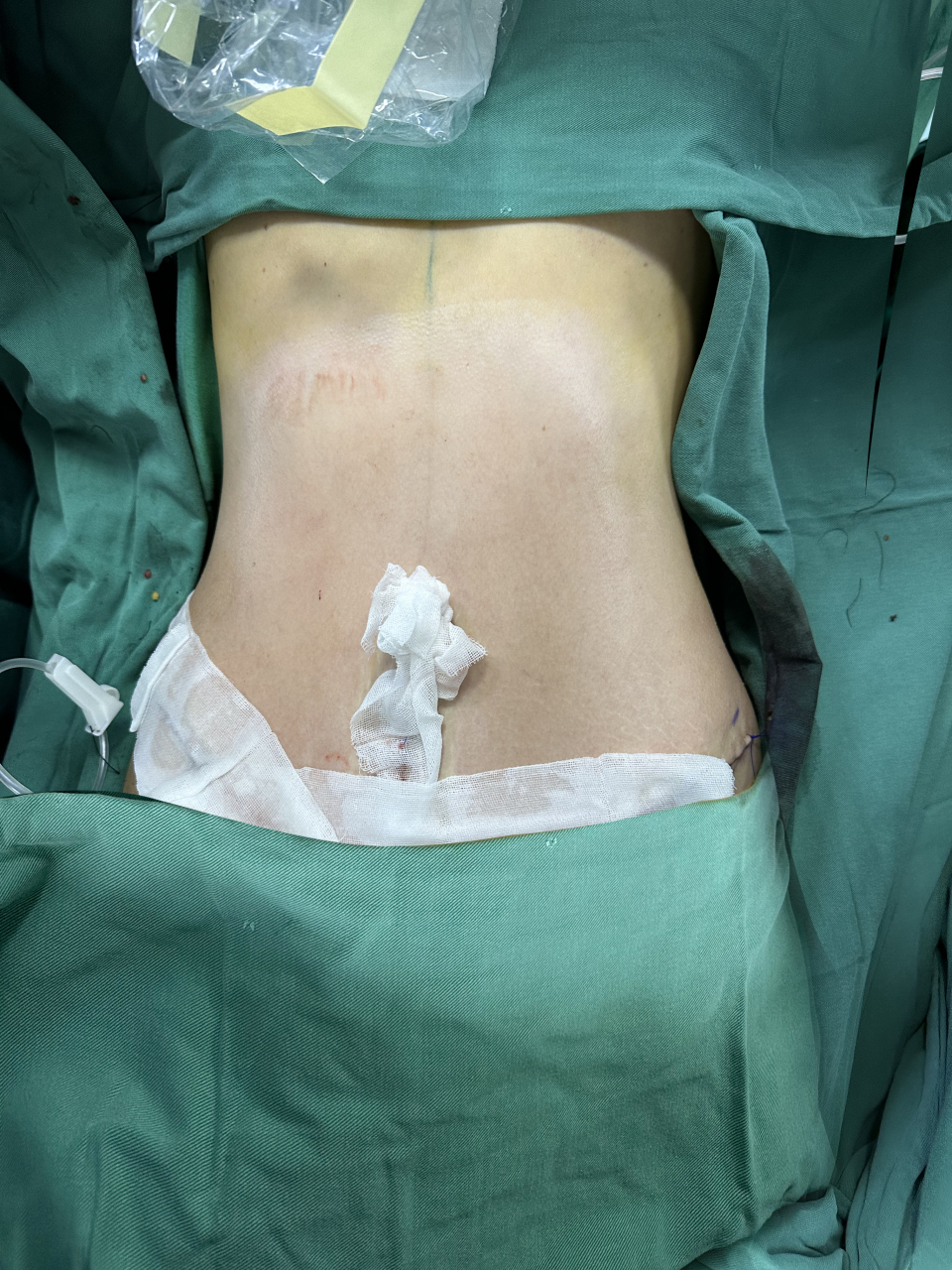 自从生完孩子,四肢虽然还很细,但是肚子就像气球