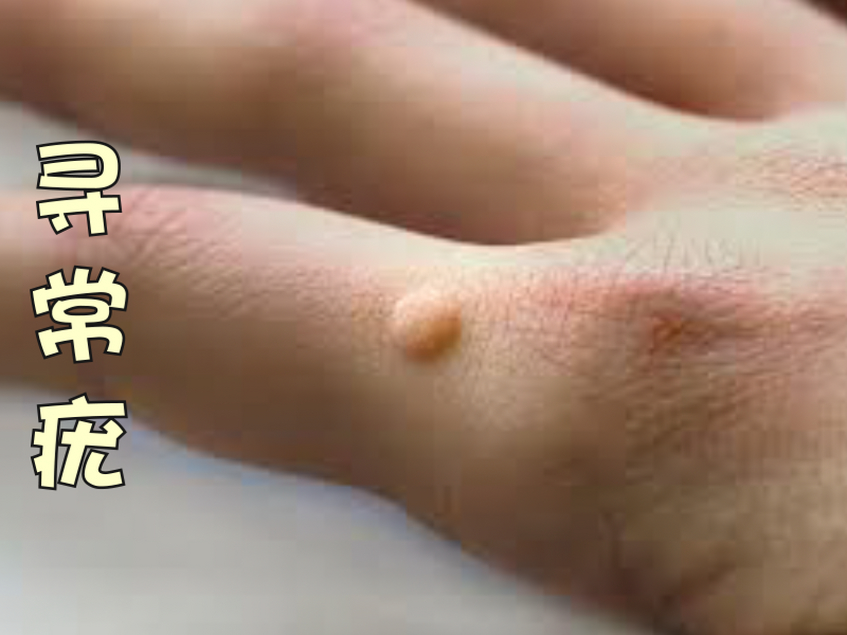 寻常疣俗称"瘊子","鱼休子",在临床上十分常见,是一种hpv病毒感染