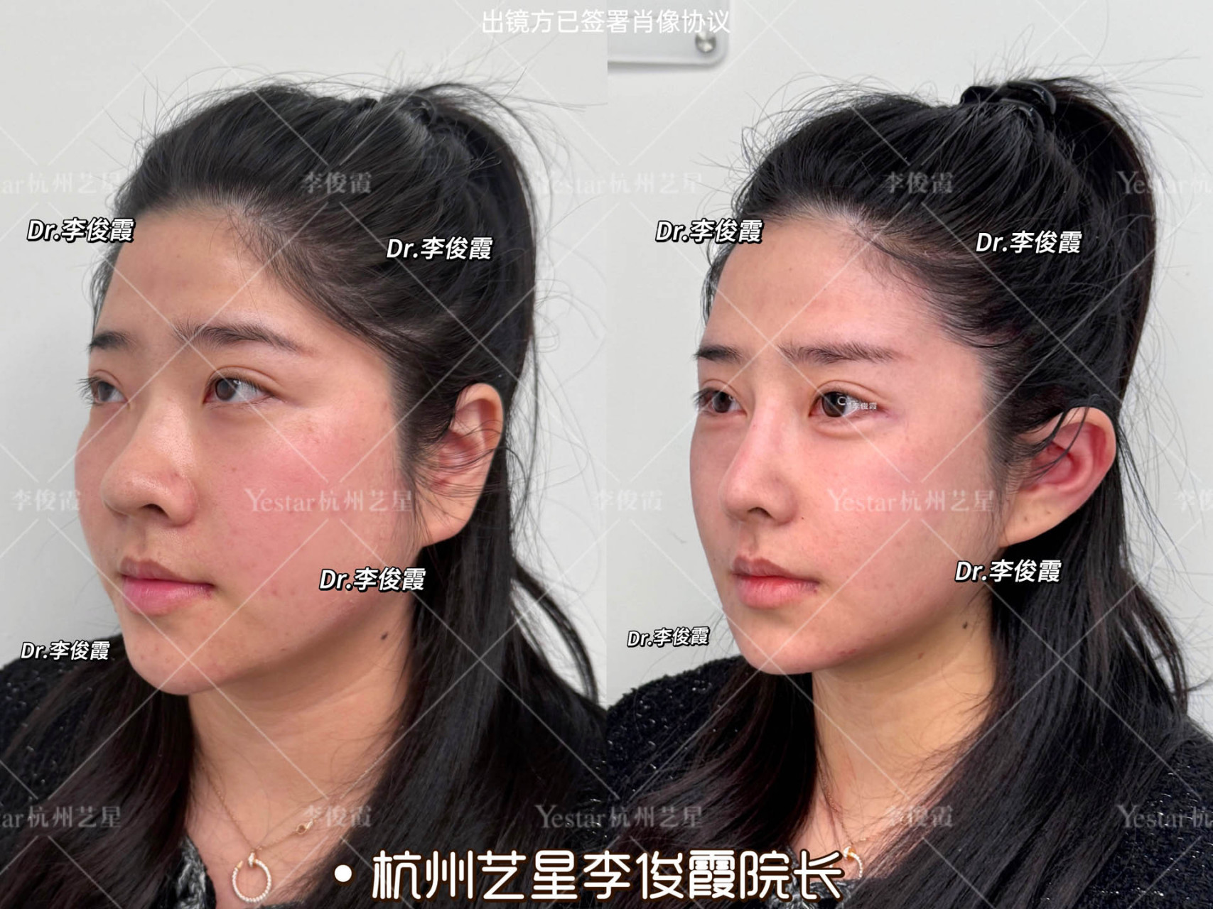 结节 额头光影美学,全脸贵气 抗衰老下垂,额颞线高光点塑造,骨相突出