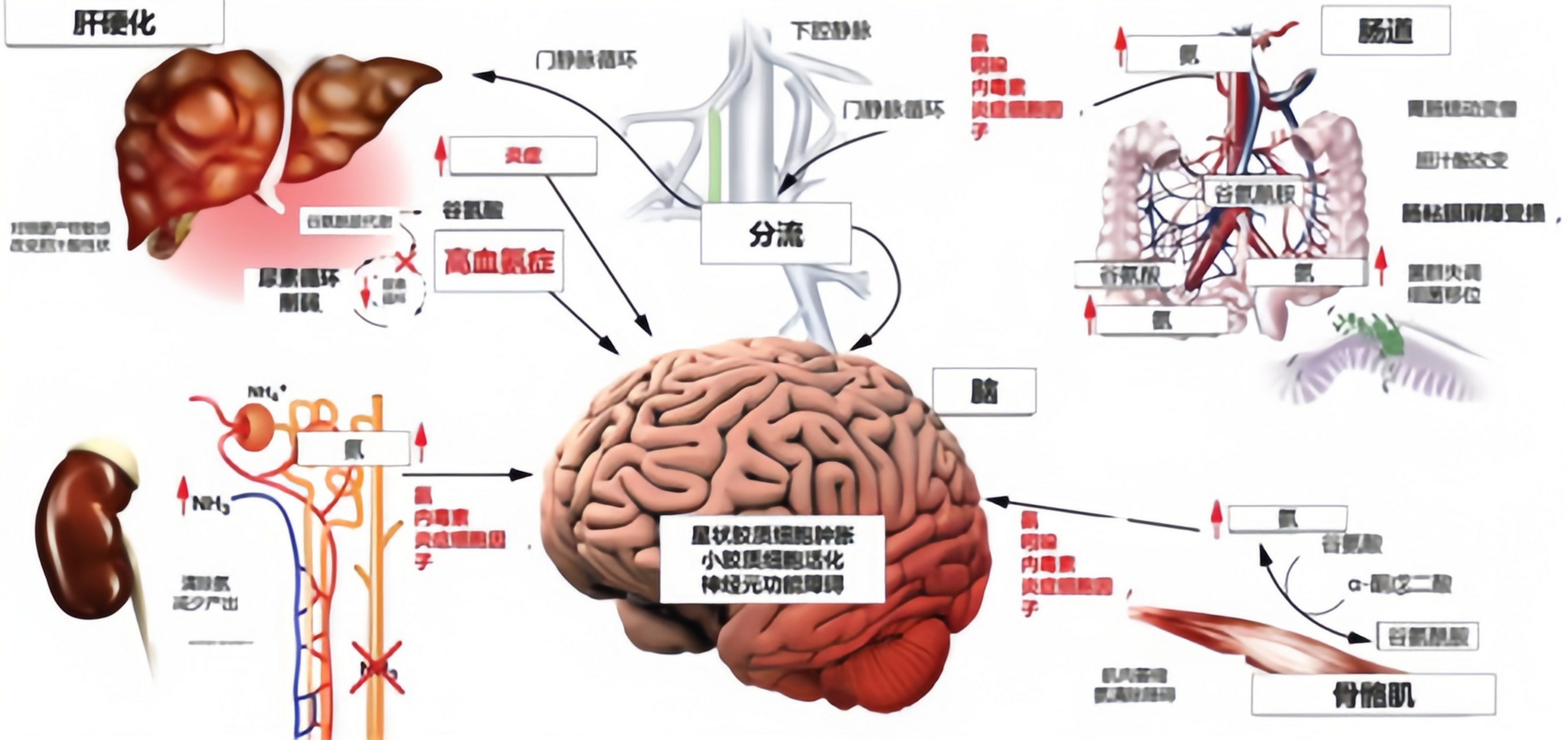 肝性脑病诱因图片