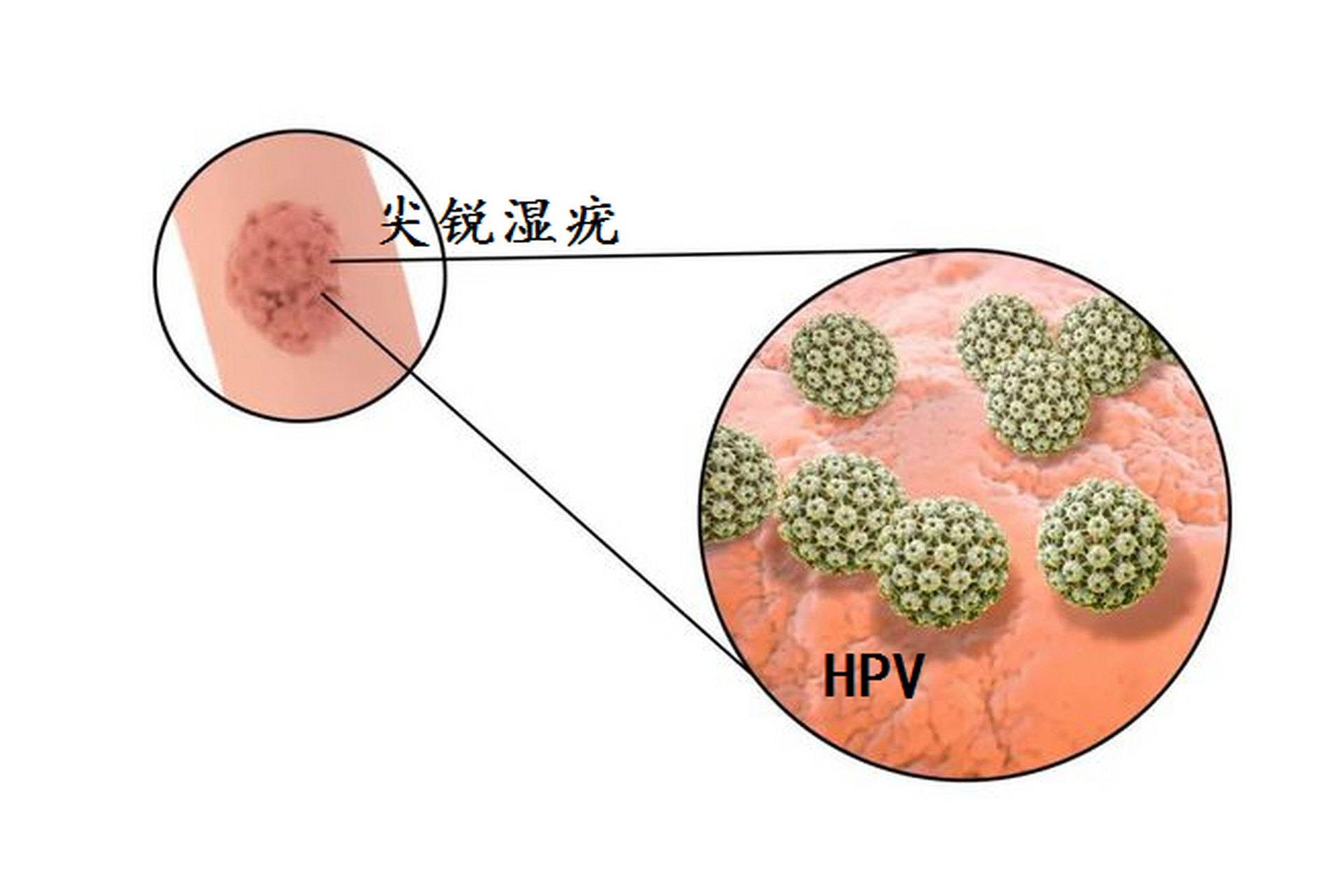 [1]尖锐湿疣可表现为大小不等的丘疹,乳头状,菜花样赘生物,这些表现