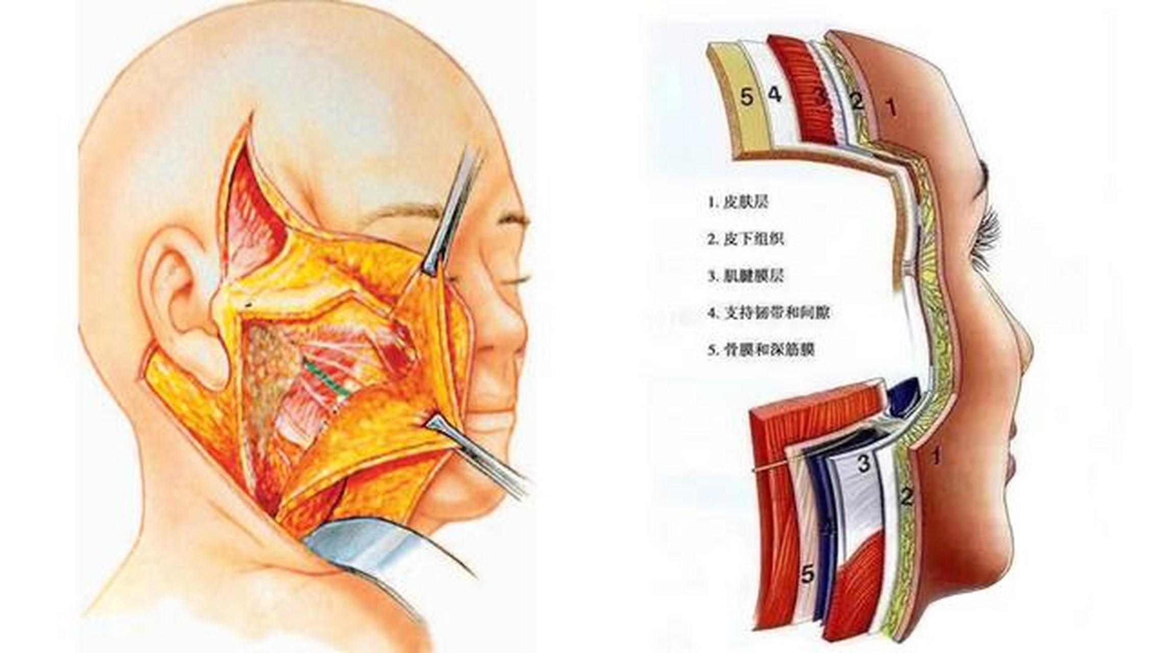 拉皮手術的核心的內容是深層組織的提升復位,多餘的組織去掉,所以拉