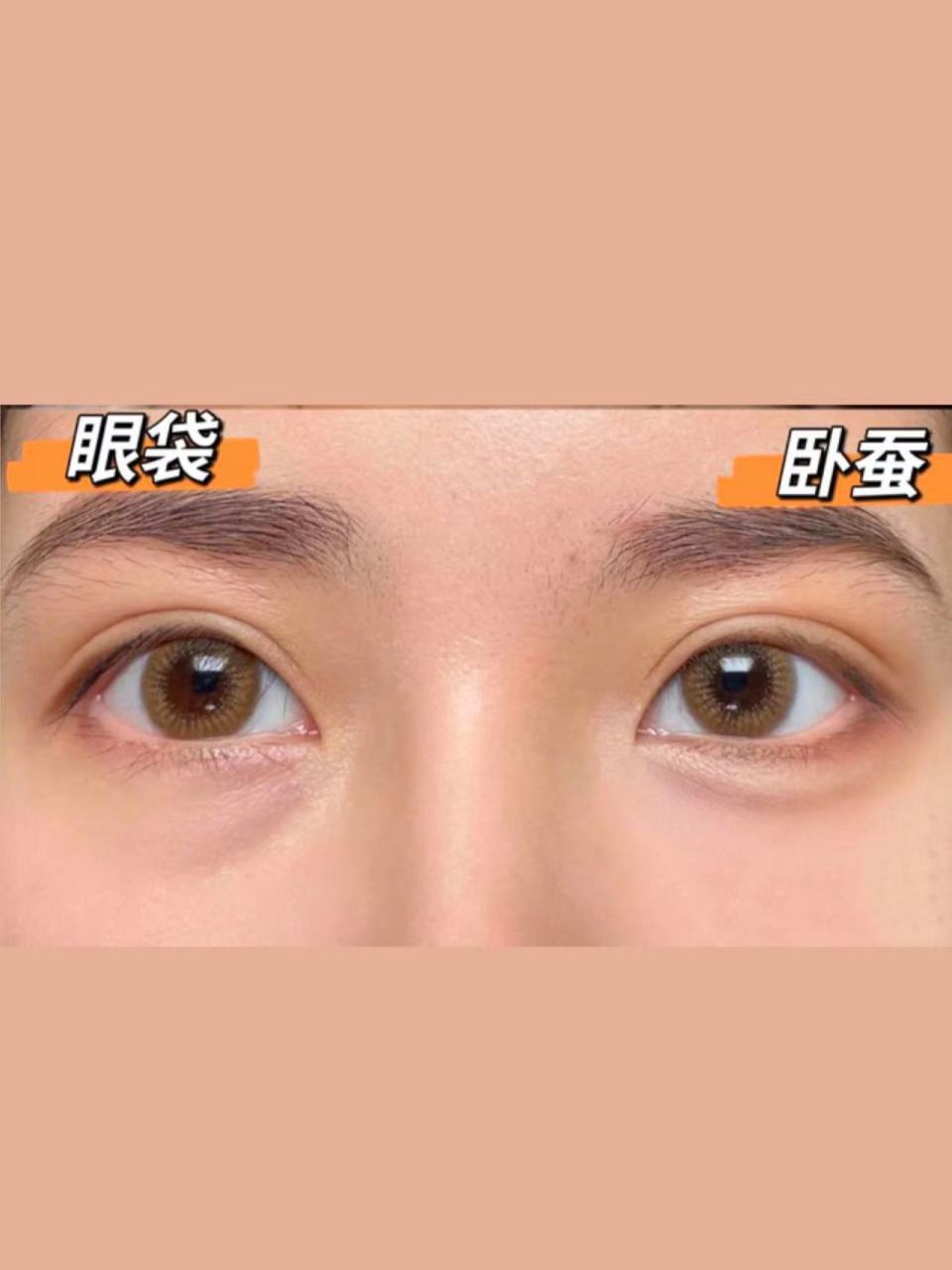 怎么做到去眼袋留卧蚕的?