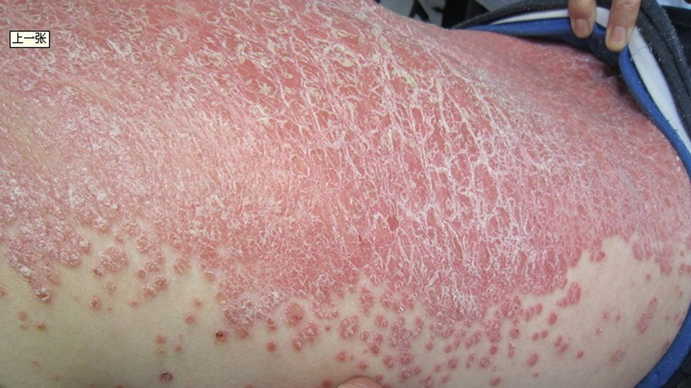 牛皮癣,是一种常见的具有特征性皮损的慢性易于复发的炎症性皮肤病.