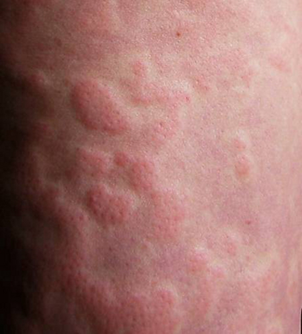 误解:荨麻疹会传染  由于荨麻疹的皮疹表现是大量的风团,疙瘩,普通人