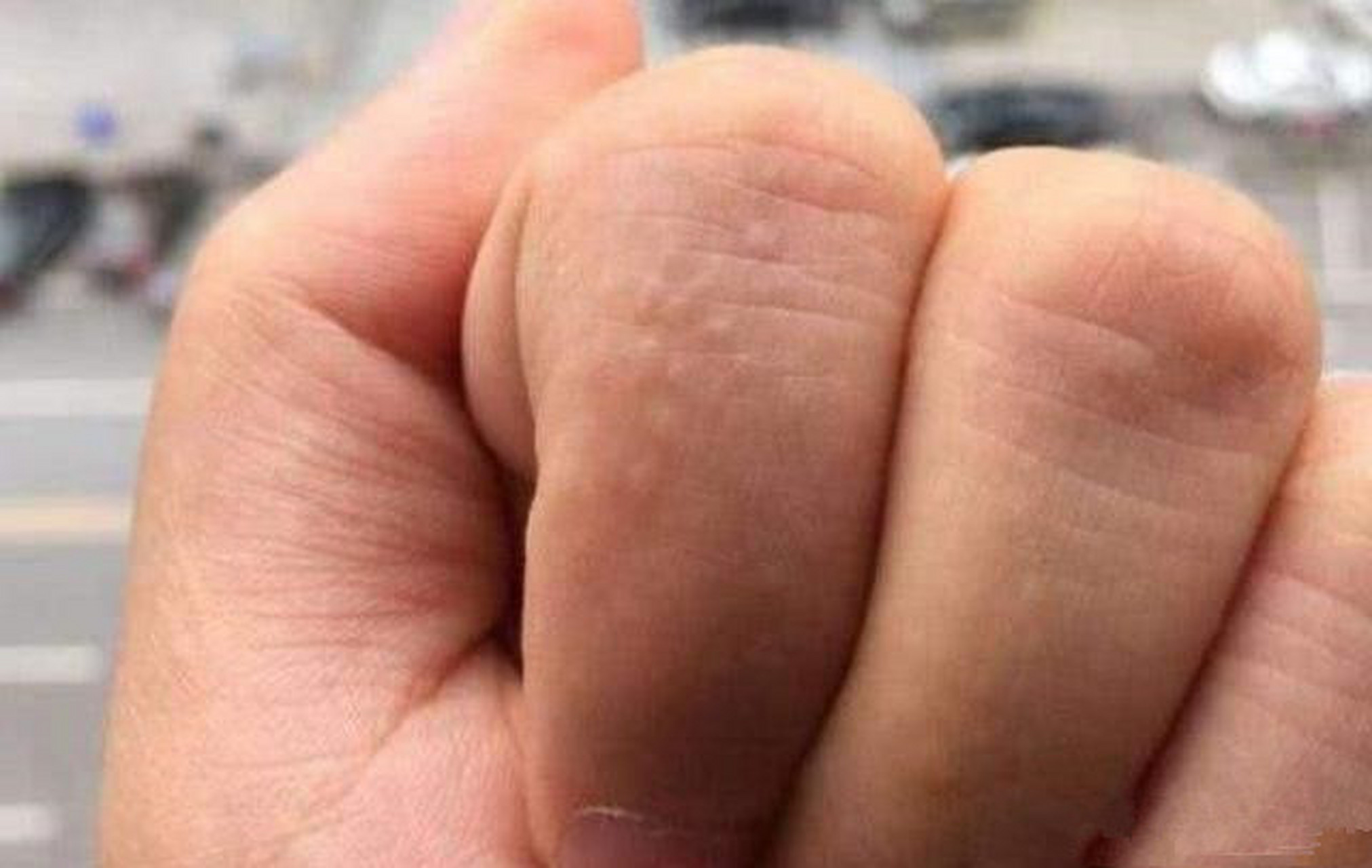 夏天手上为何会长汗疱疹?大人小孩为何都避免不了?  汗疱疹属于湿疹的