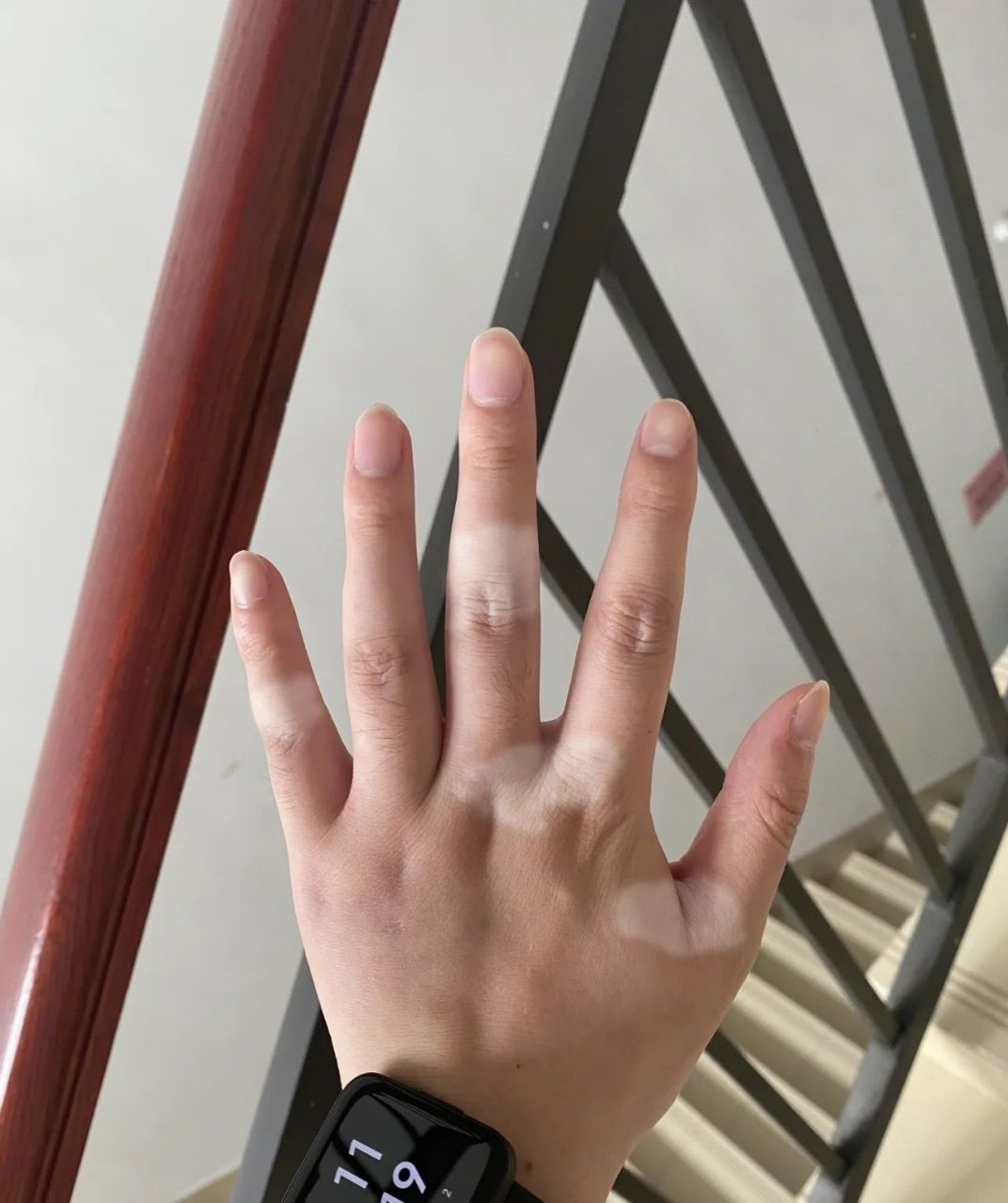 手指关节都有,网上查了很多资料,说治不好,特别的崩溃,告诉她手上