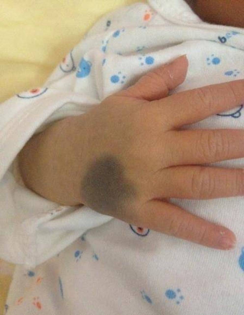 太田痣可能由常染色体显性遗传引起,是皮肤黑素细胞错构瘤.