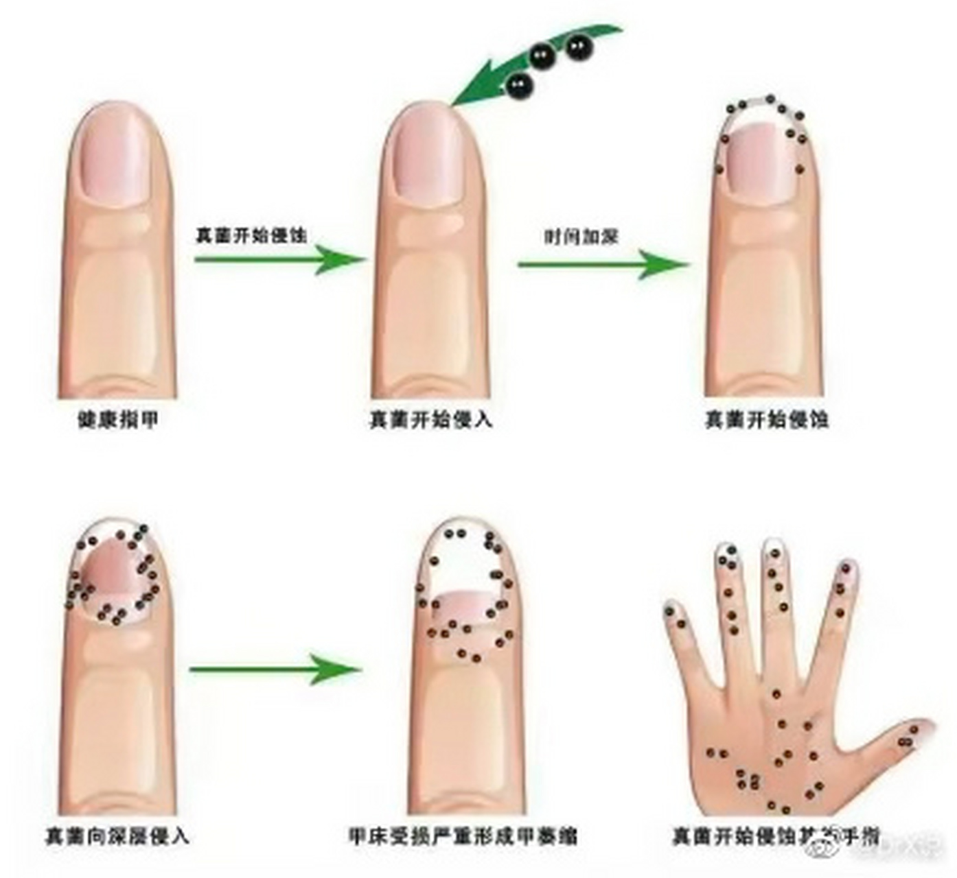 灰指甲不痛不痒可以不治吗#灰指甲属于甲真菌病的一类,甲真菌病是由