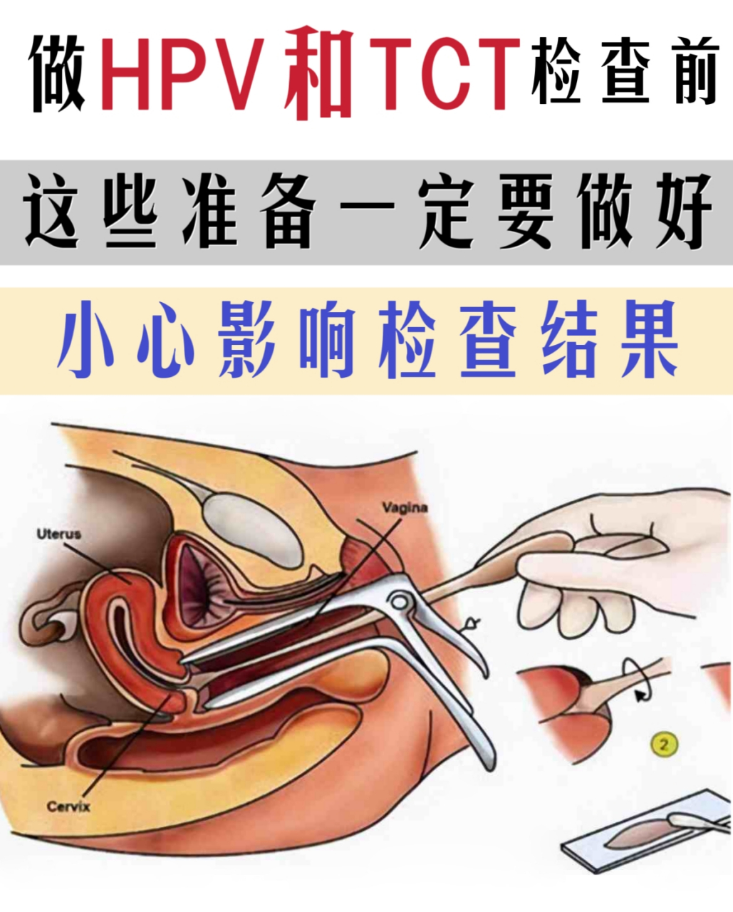 宫颈筛查hpv和tct前一定要符合以下条件,否则影响结果!