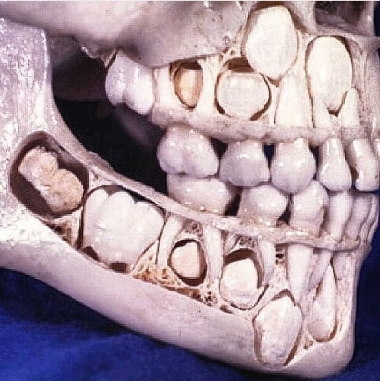 一个小孩的颌骨拍片,未长出来的恒牙其实也是乱七八