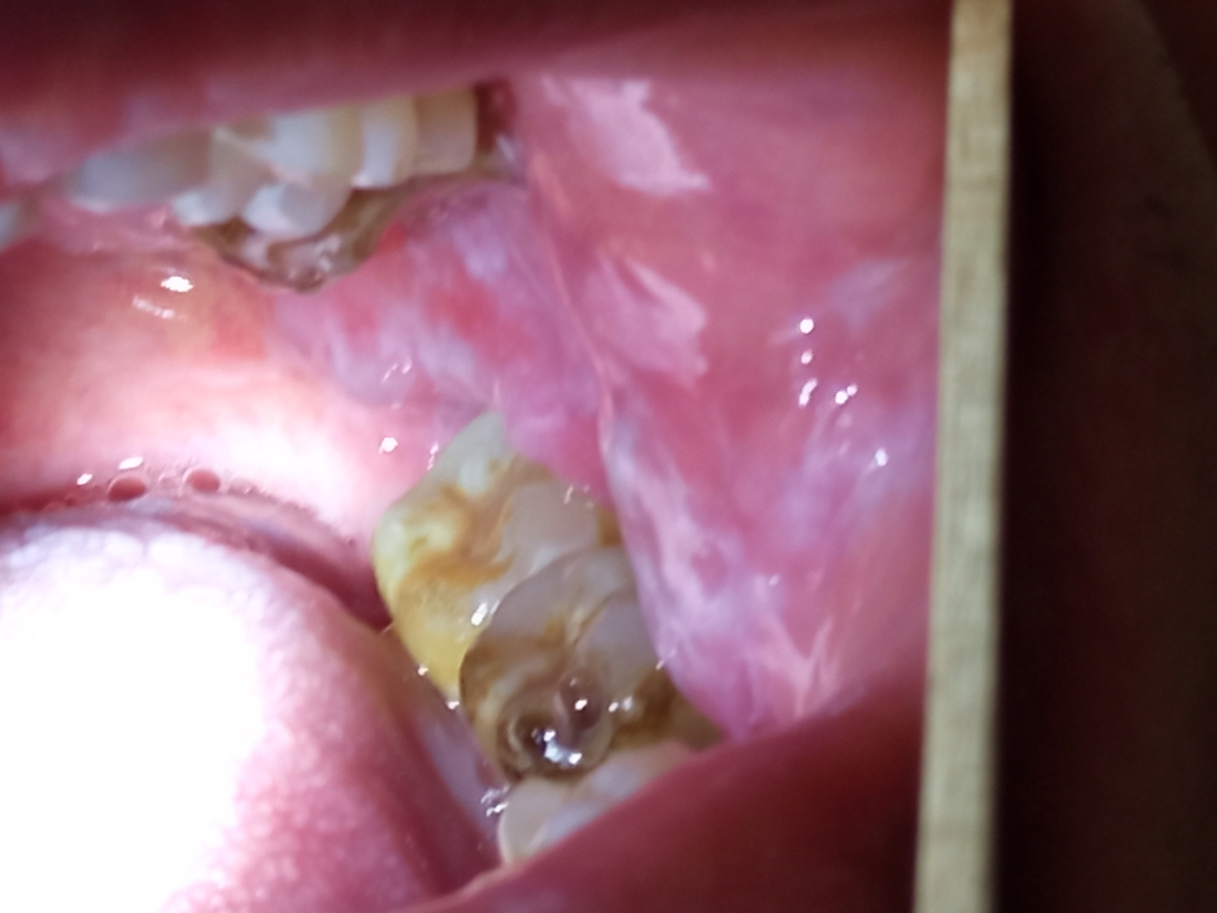 家属说父亲今年已经72了,去年年底查出有口腔扁平苔藓,并且嘴里白纹越