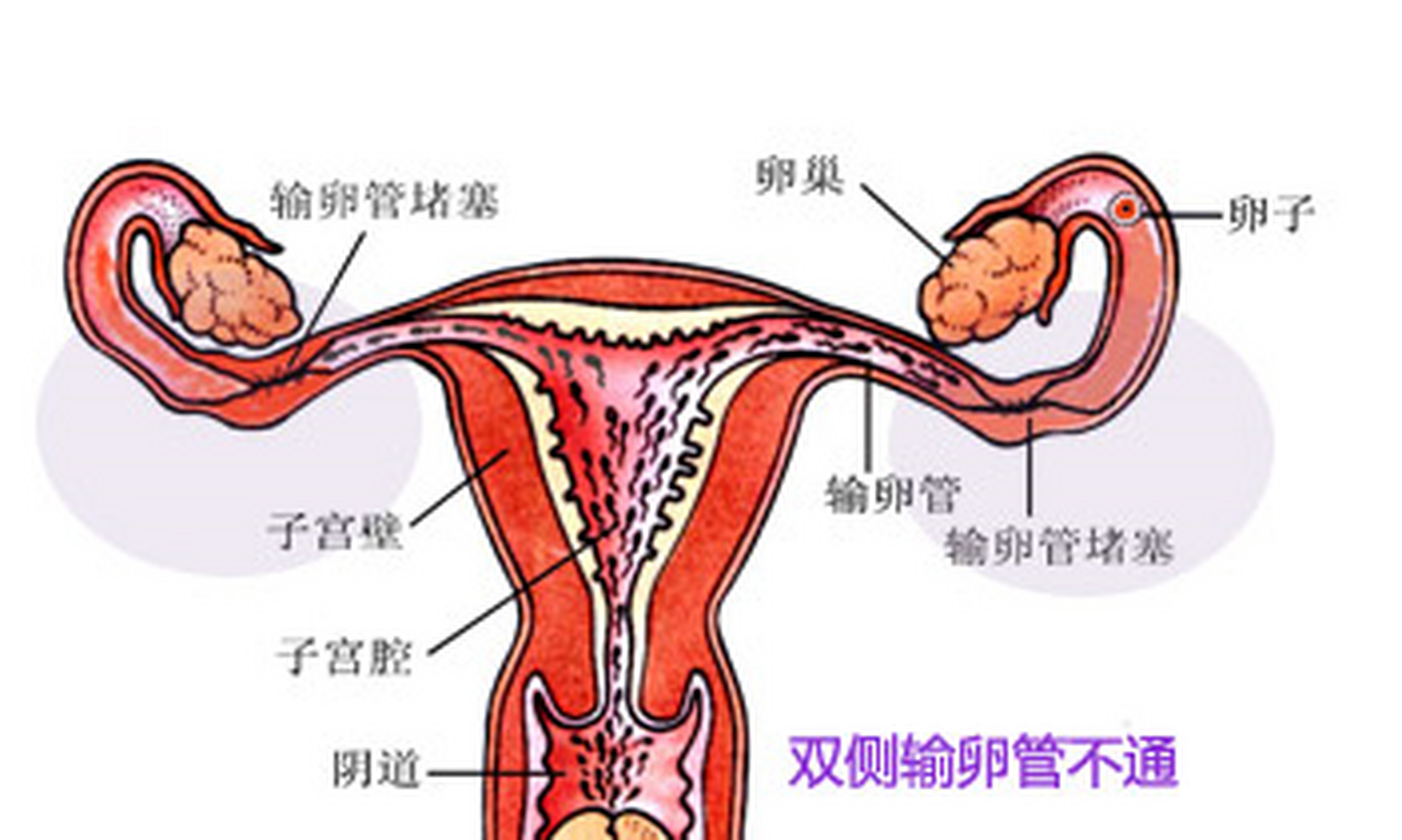 输卵管的通畅性检查常用的有输卵管通液,子宫输卵管超声造影,x舷侣