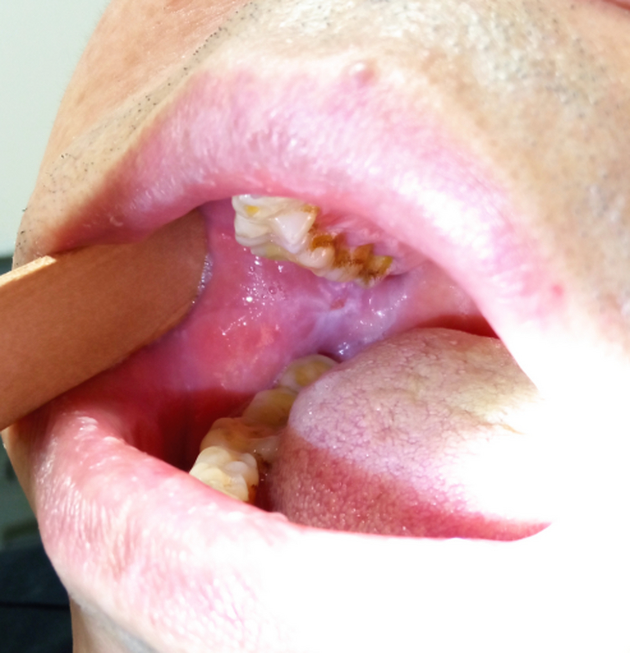 "  上午来了一位患者嘴里长白纹已经一年多了,患者说自己去年发现自己