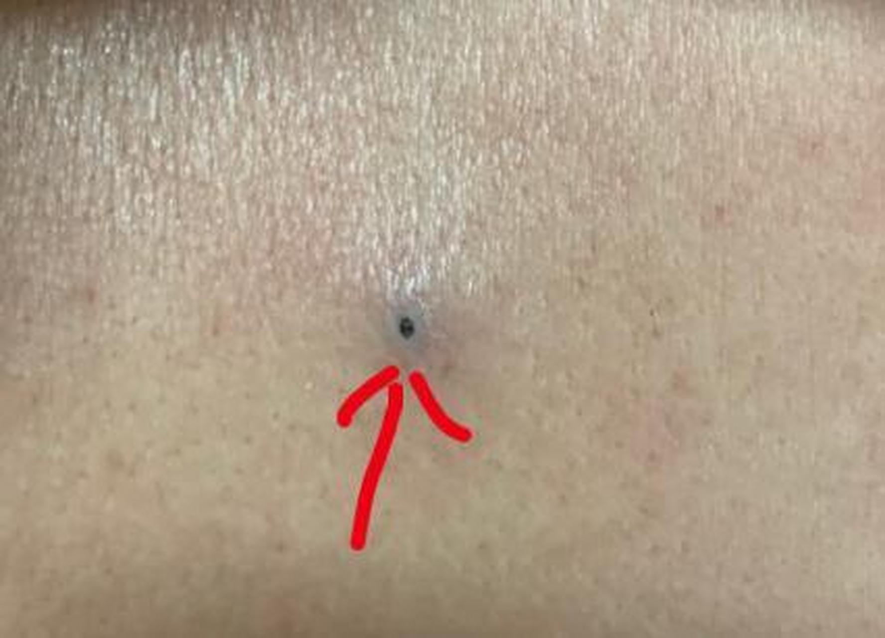 也叫粉瘤,那个黑点就是皮脂腺导管的开口,可以挤出来一些豆腐渣样的