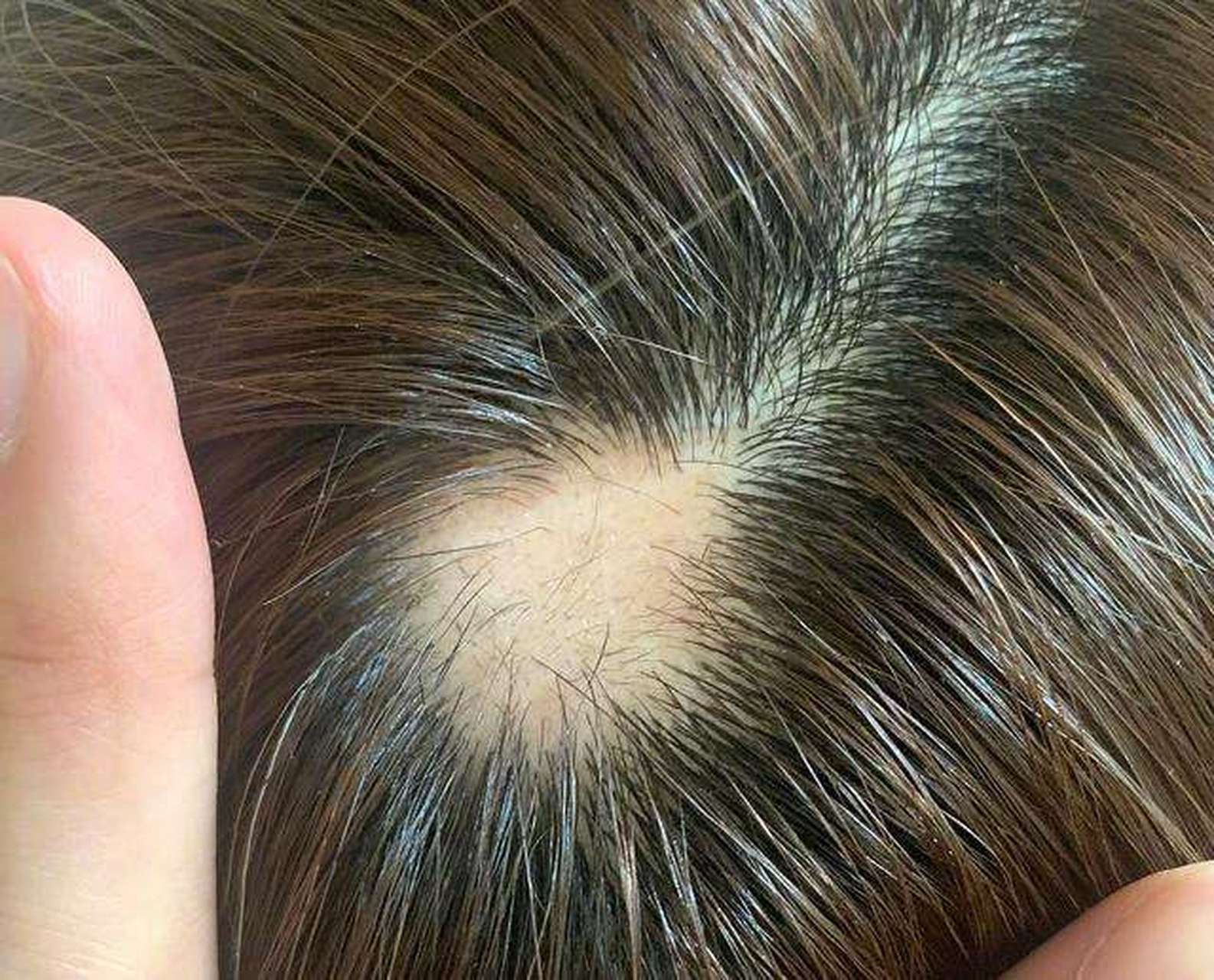 斑秃# #赣州肤斗士# 头发秃了一块原因是斑秃,斑秃就是突然发傻的