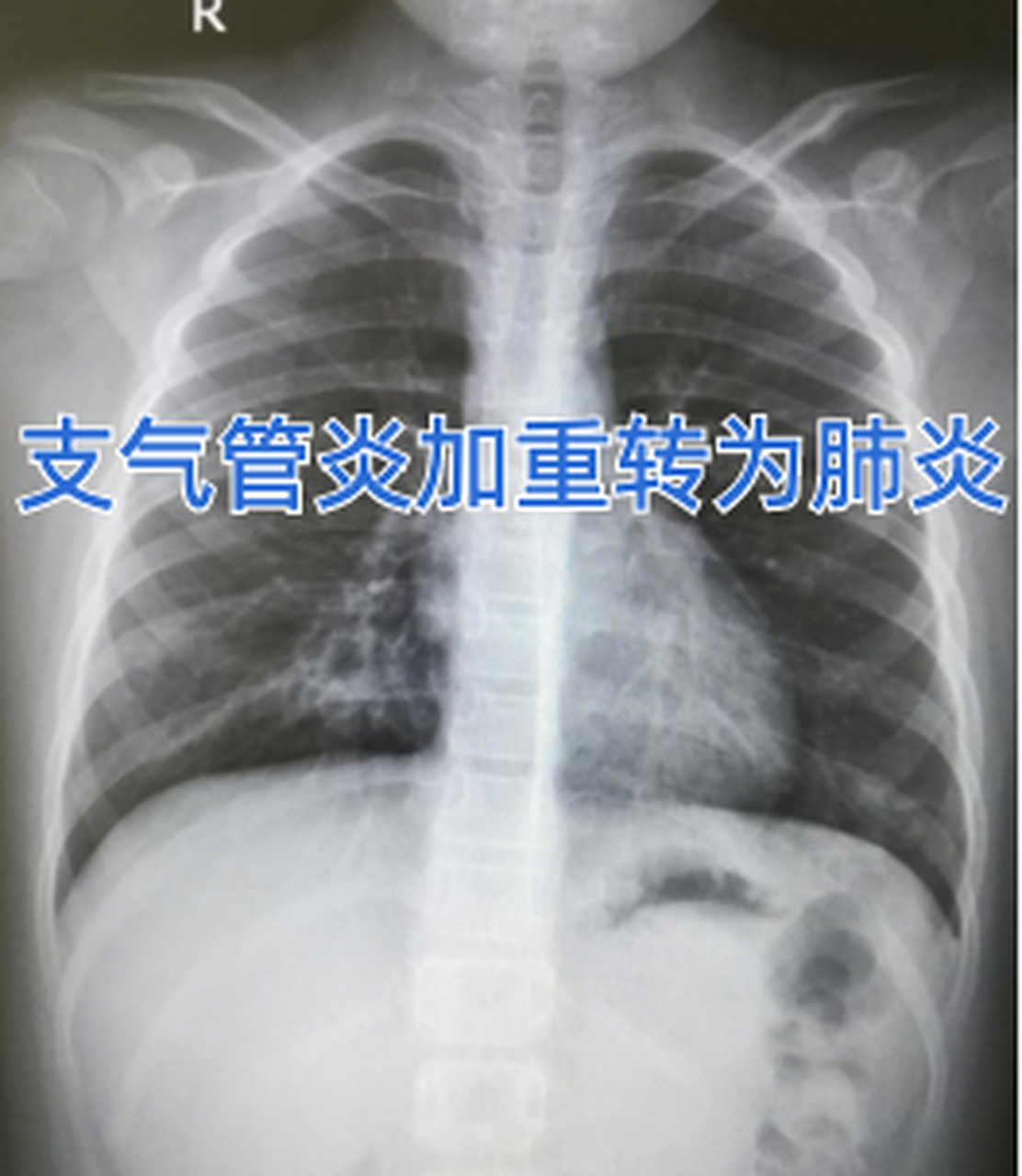 支气管炎加重转为肺炎  小孩今年3岁了,因为在家没人带,所以就把她送