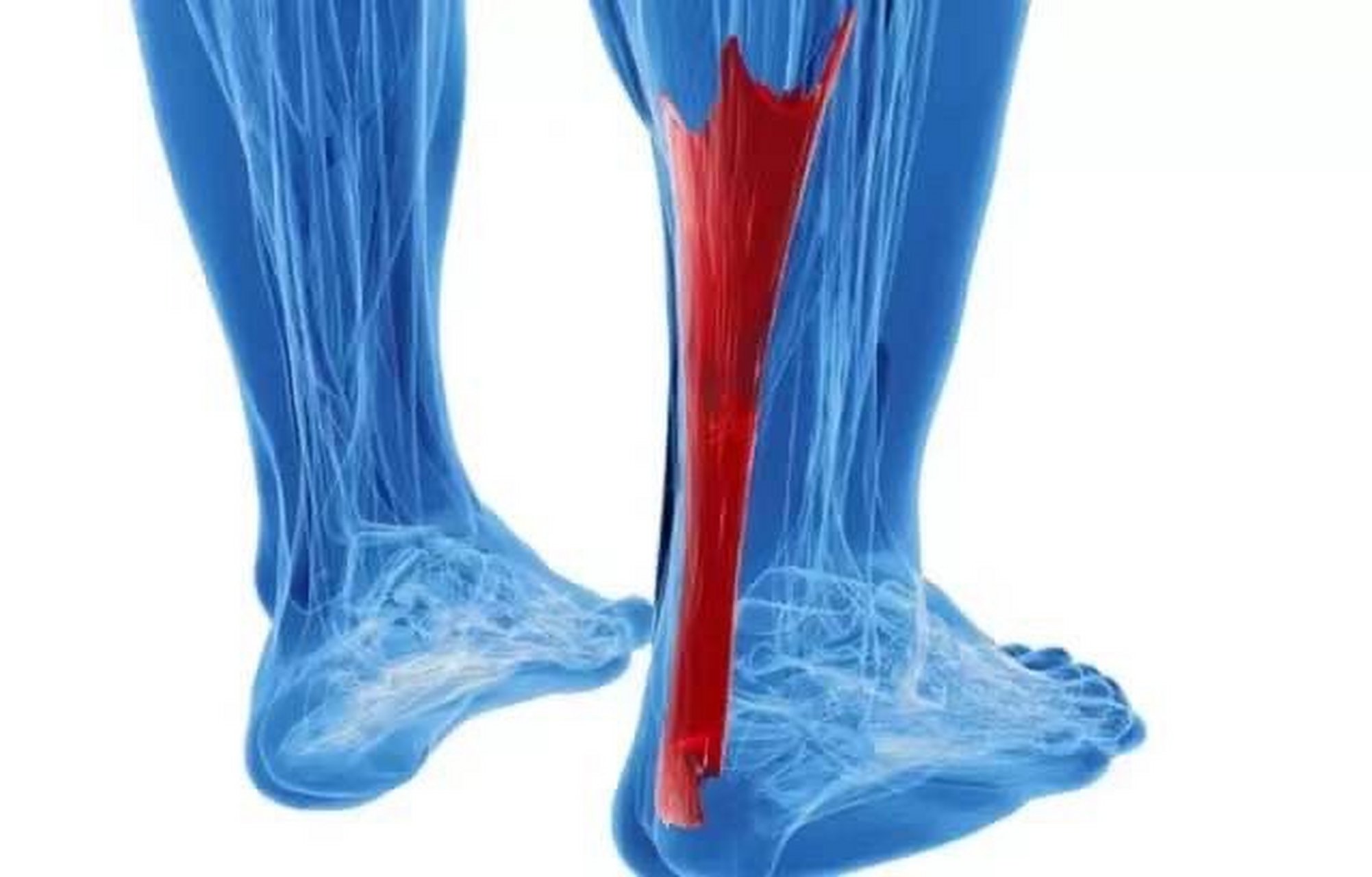 阿基里斯腱(achilles tendon),俗称跟腱,脚筋