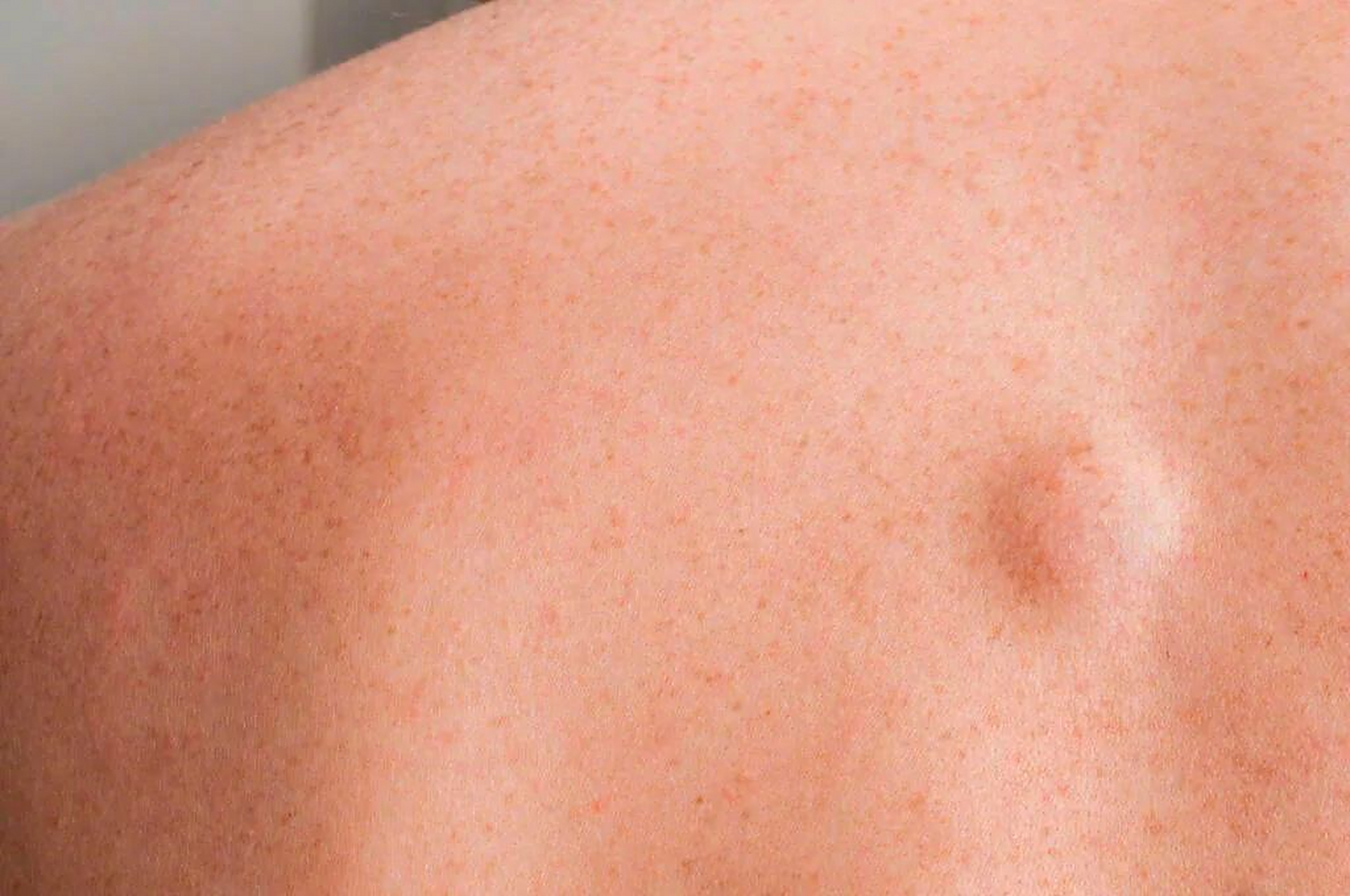 突然发现自己身体上长了个小疙瘩,  摸起来软软的,但不痛不痒,没什么