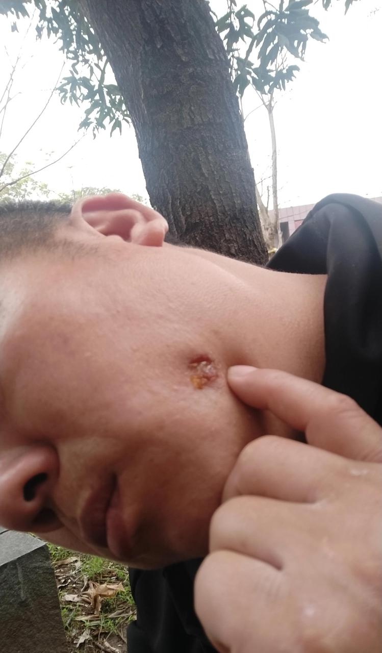 脸上的东西长了4年了,还是没有痊愈,擦了各种药都没有效果,  由于没有