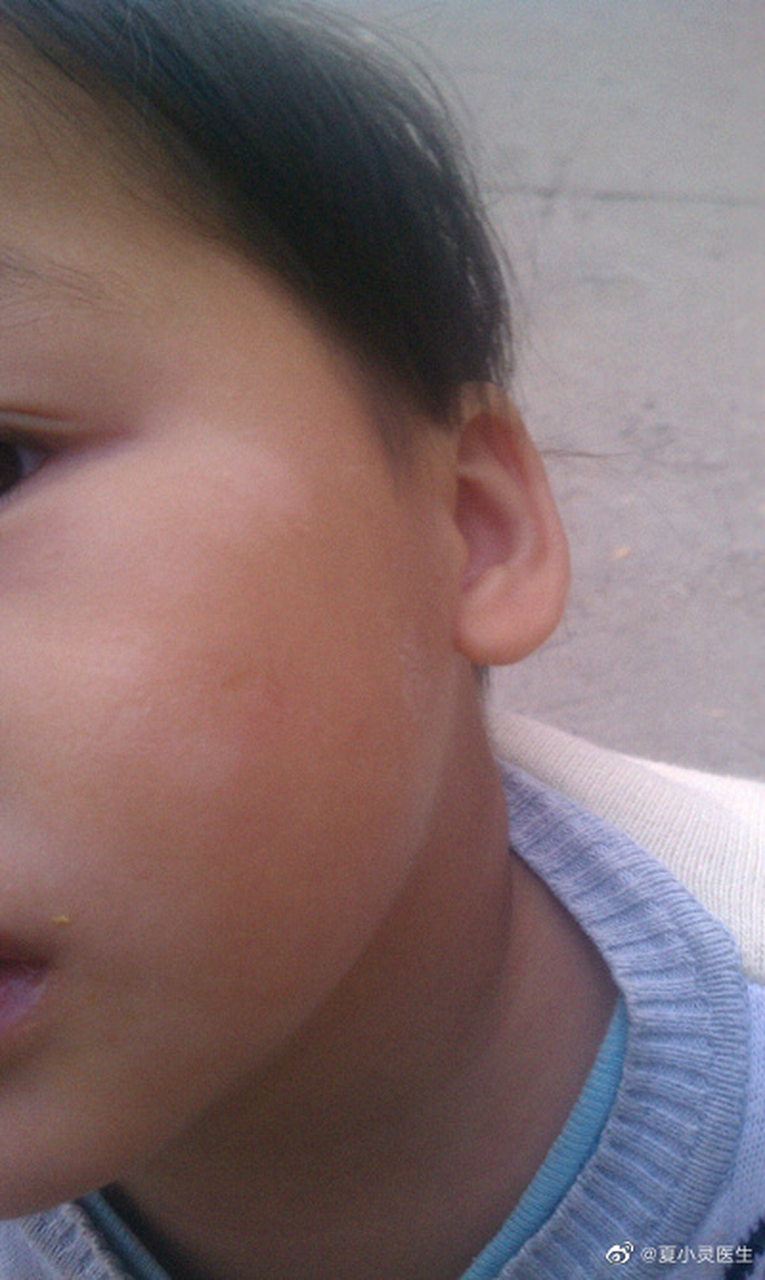 一,临床表现:  1,症状——为白斑颜色萎黄,好发于面部及口唇,小儿