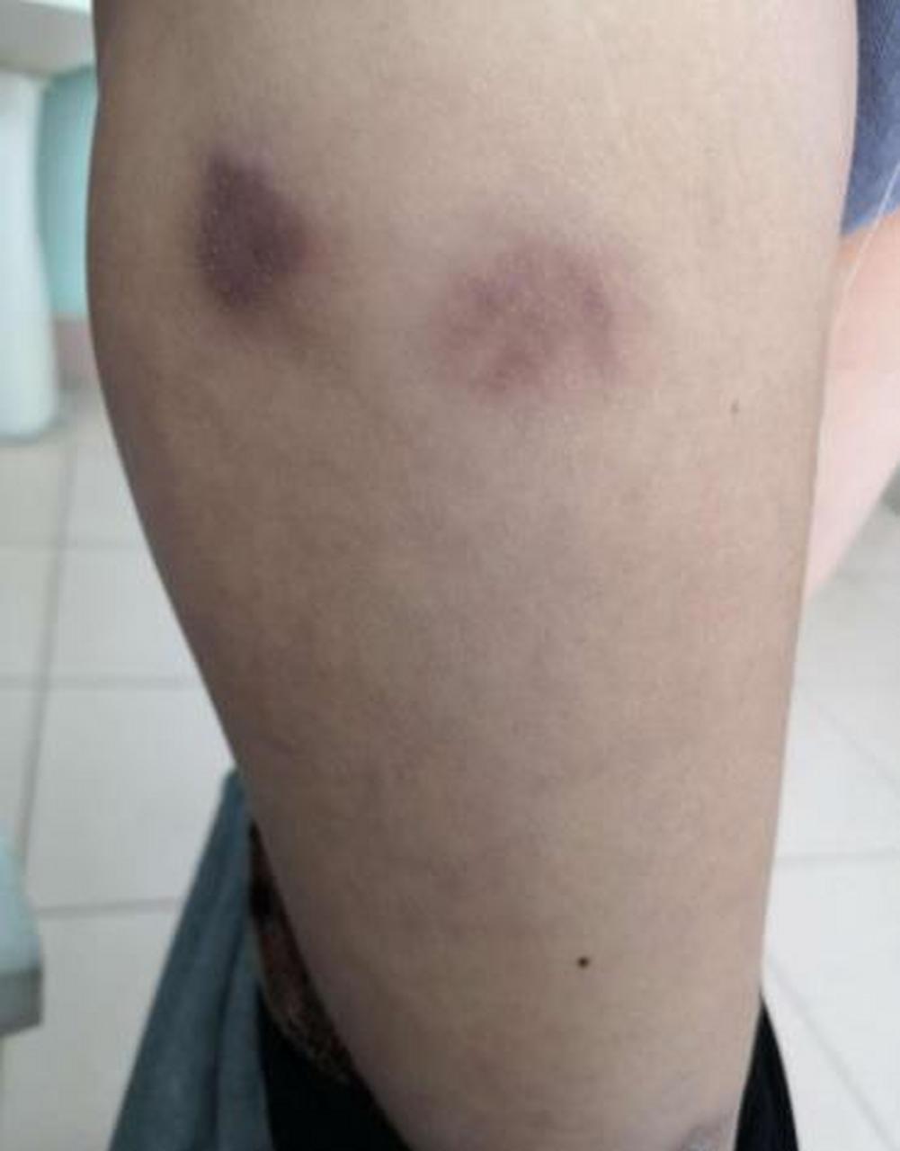 狼疮性脂膜炎是红斑狼疮一种,又称为深部狼疮,引起皮肤损害.