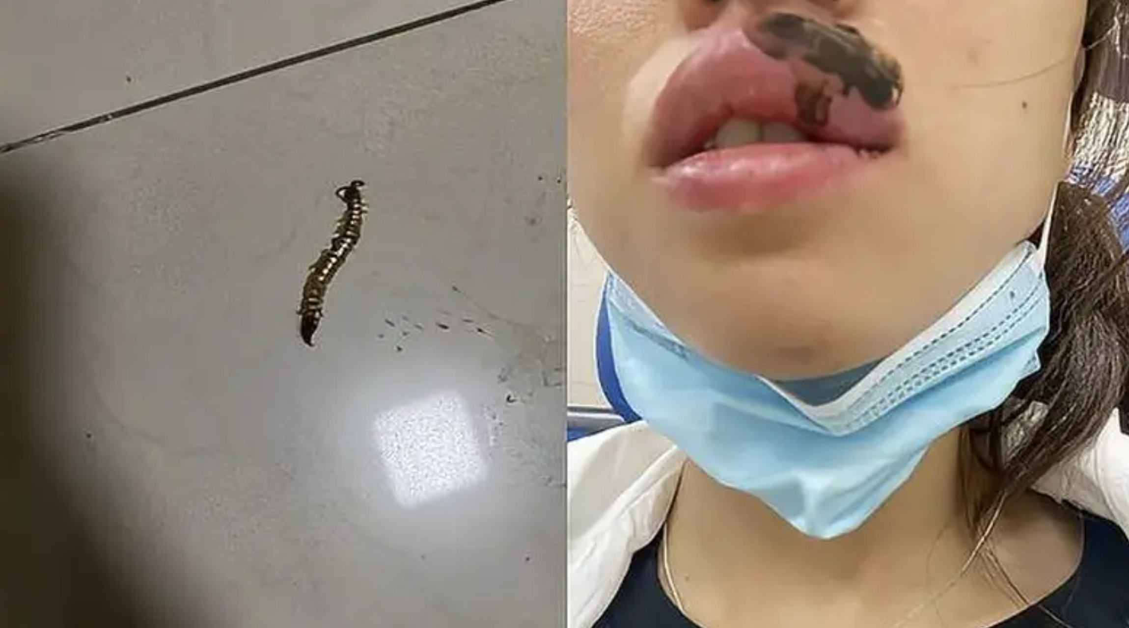女子睡觉被蜈蚣咬醒嘴肿成香肠#   近日,江苏常州一名女子在睡梦中