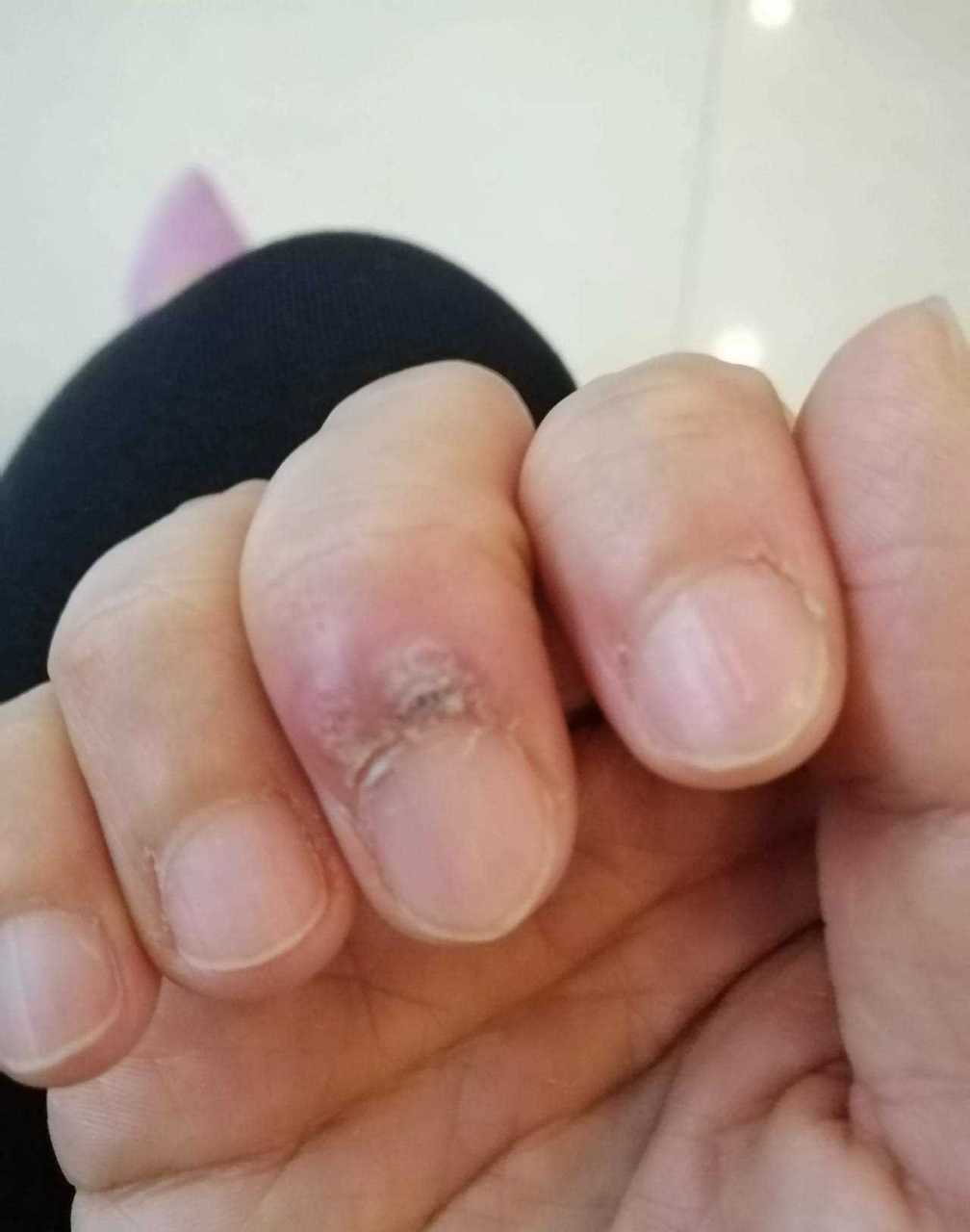 昨天特地去医院处理了一下我手指上的两个疣.