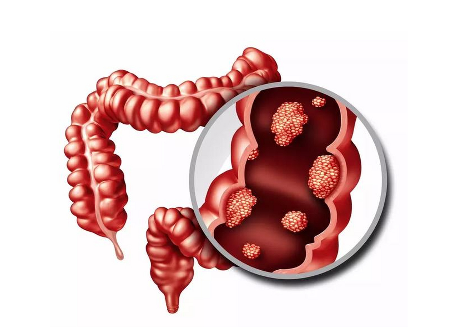 结肠多发息肉会癌变的几率大吗? 结肠多发息肉,是不是就是癌症了?那这