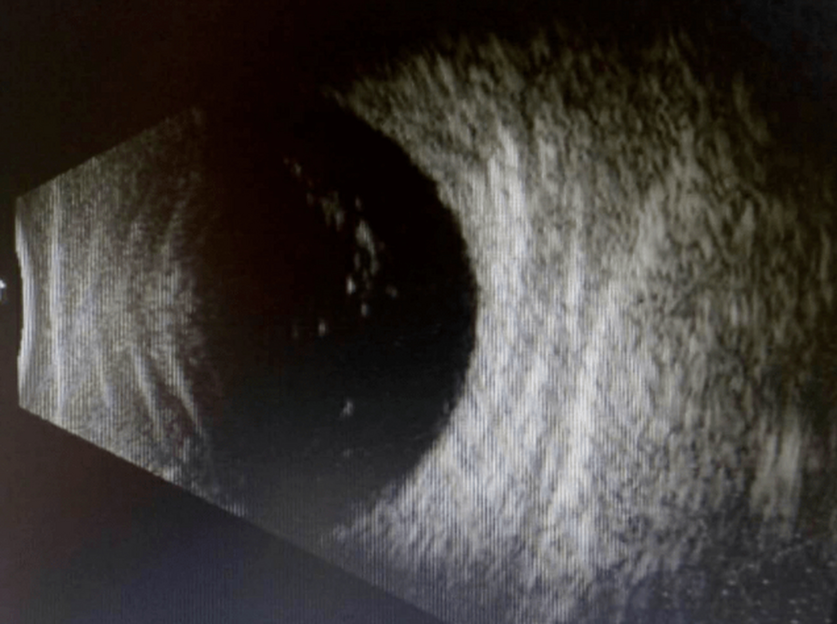 玻璃体浑浊分为病理和生理性的,所谓的生理性就是玻璃体浑浊的病人