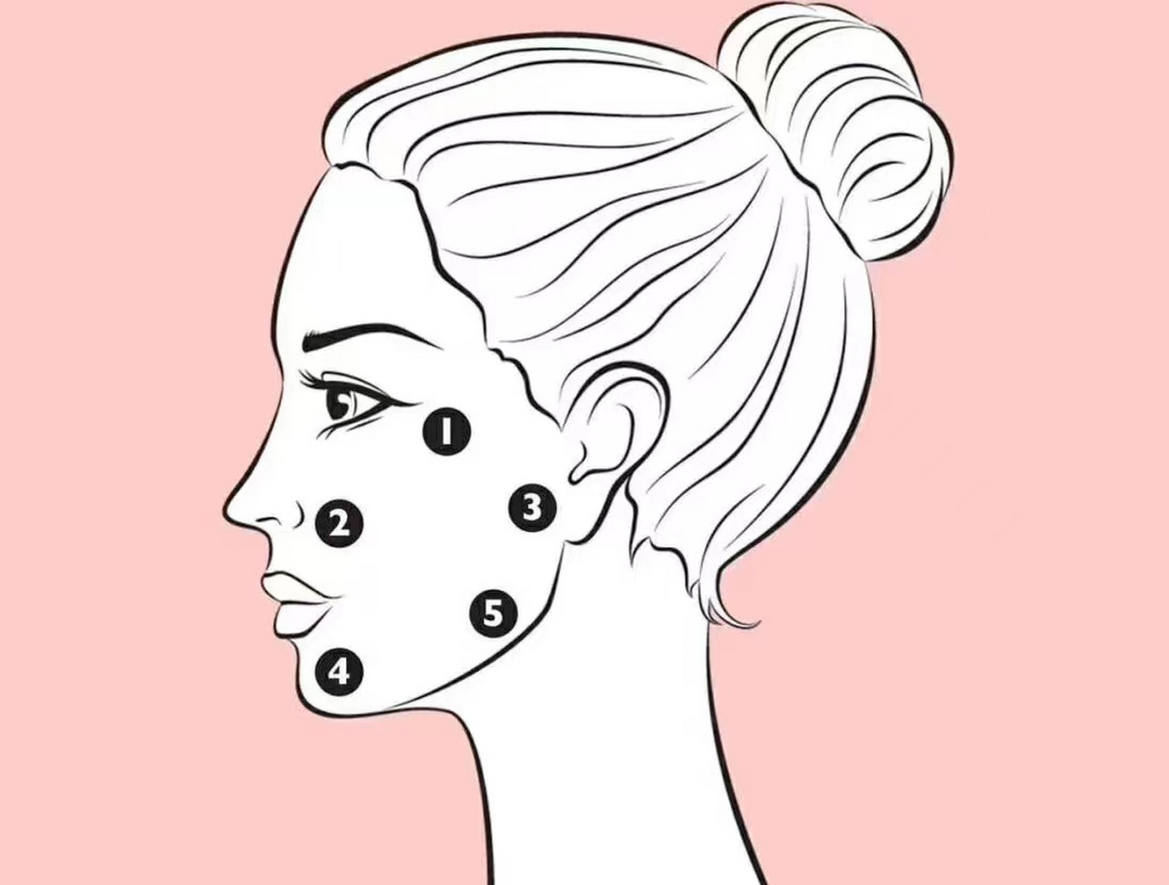 瑞士profhilo五点提升针的定点方法 比利时五点提升是第一个用于治疗