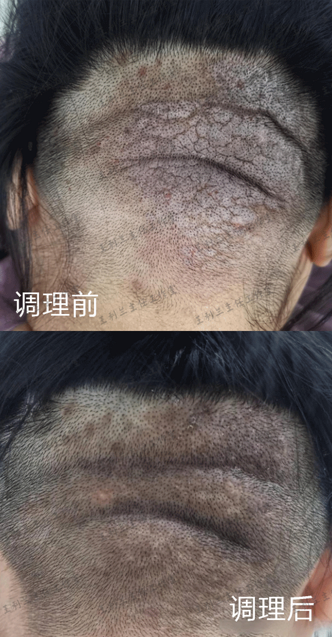 他患毛囊炎也有3年了,尝试过不少方法但病情一直未得控制,渐渐地疙瘩