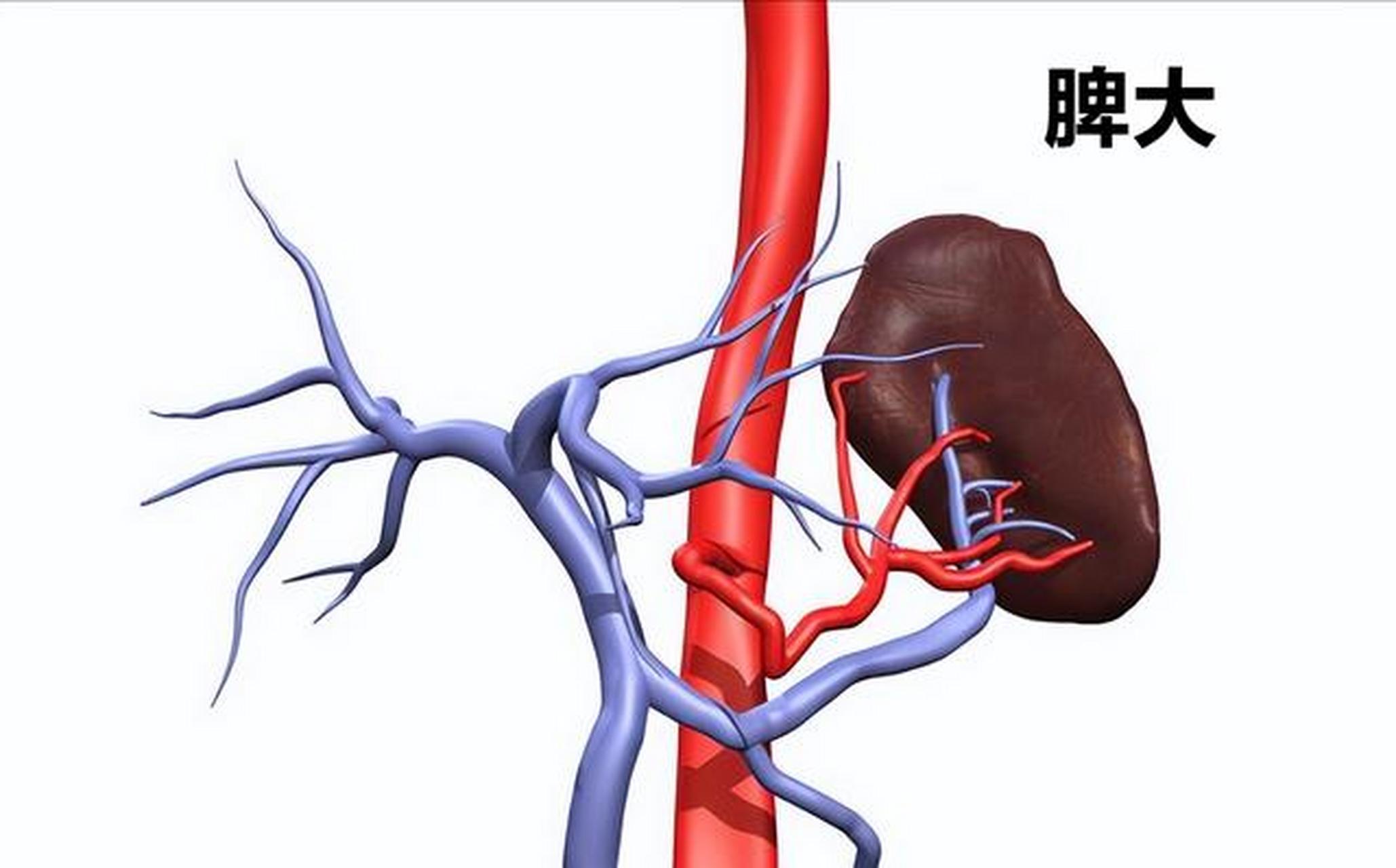 肝硬化脾肿大是一个很常见的现象,主要是因为门静脉回流受阻,门