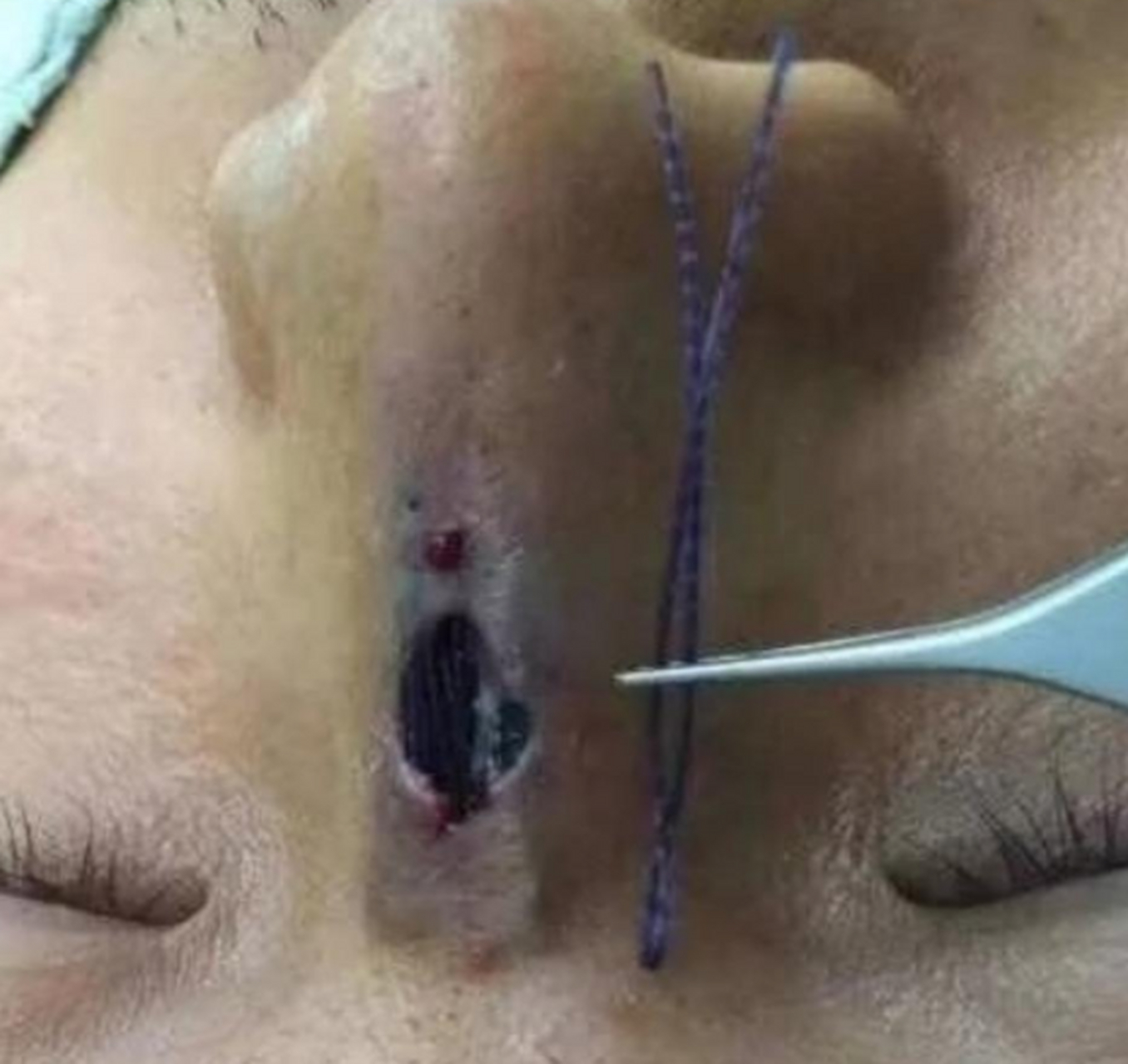 在这里我建议大家不要轻易去尝试#线雕隆鼻#