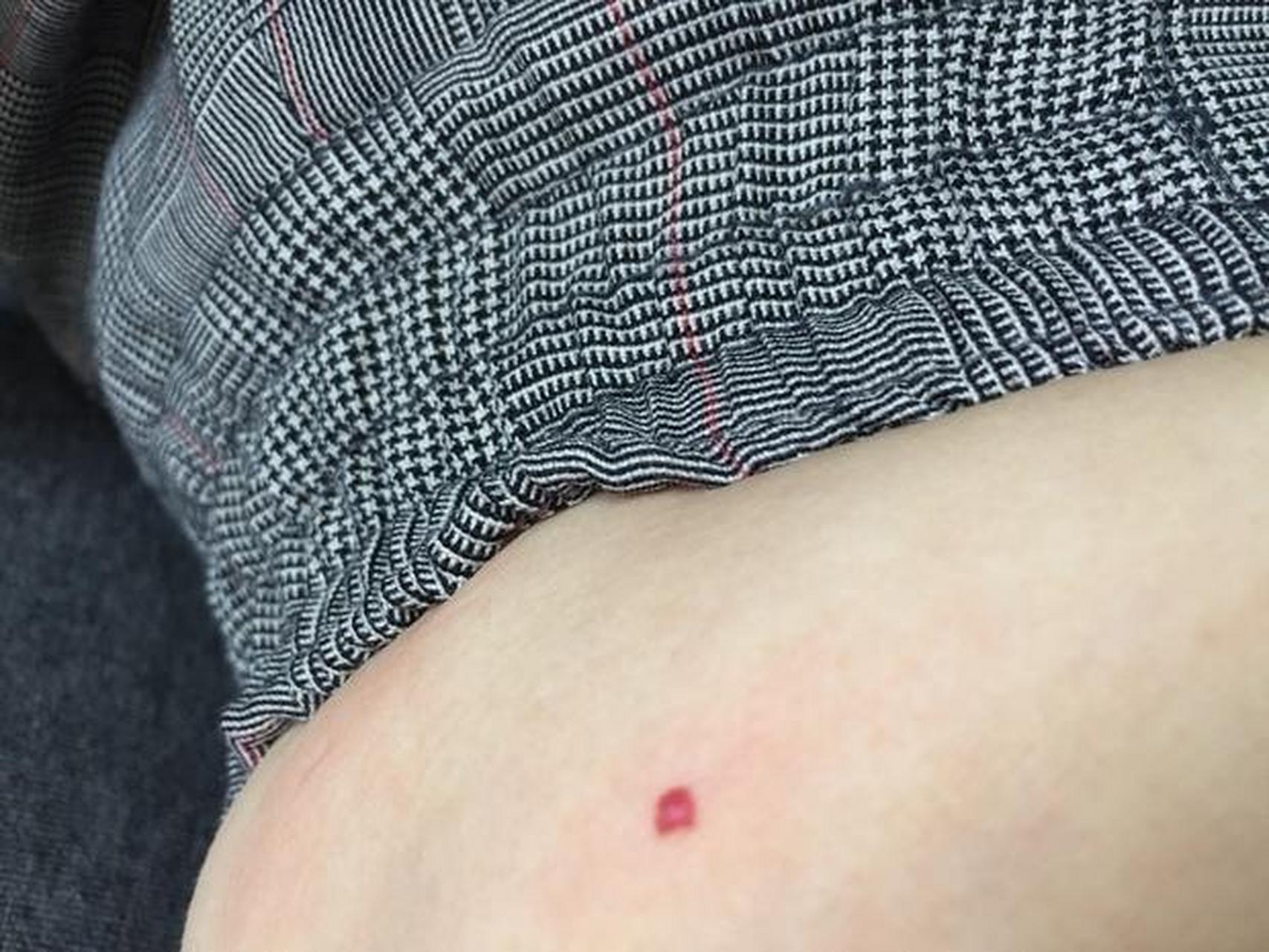 虽然血管痣也叫「老年性血管痣」甚至「老变形血管瘤」,看名字好像