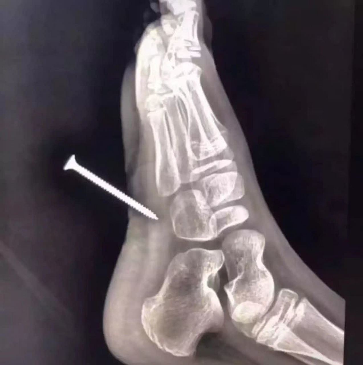 走路时不小心踩到钉子,去医院得了破伤风,下午又踩到钉子了,还需要