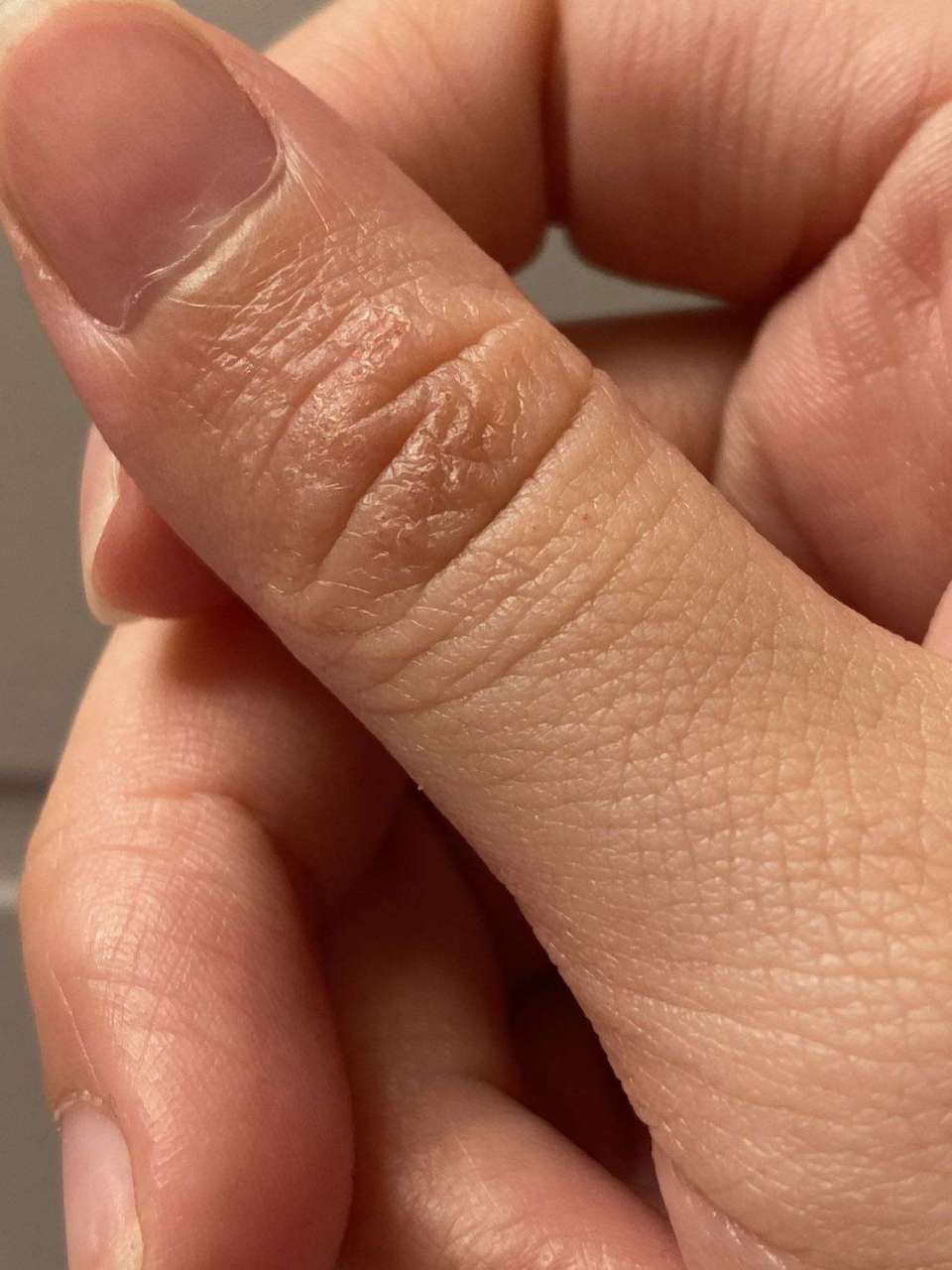 手指瘙痒起小水泡,请问是湿疹还是汗疱疹?