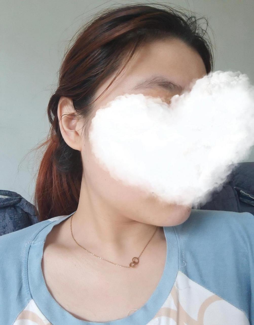 day6瘦脸针第六天注射瘦脸针仿佛又有所减小,或许只是心理作用.