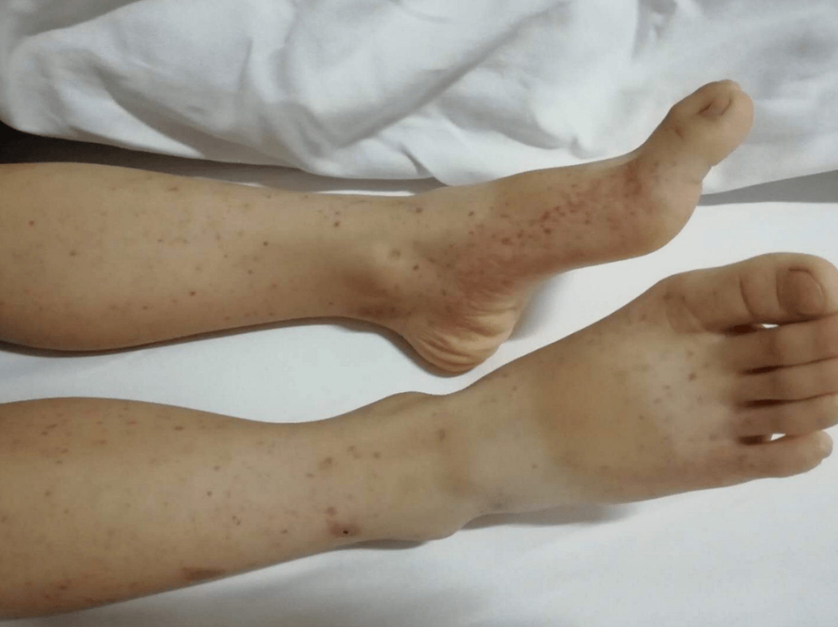 【注意】这些过敏性紫癜病人复发率很高!